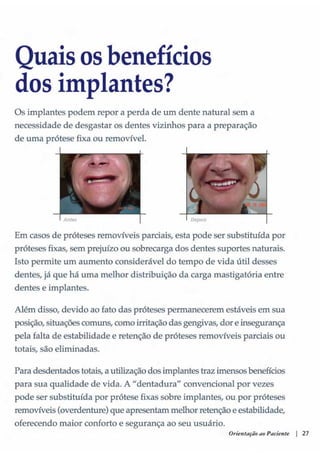 Guia orientacao implantes