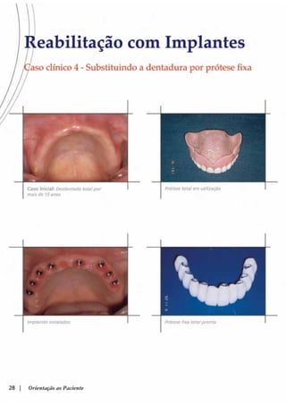 Guia orientacao implantes
