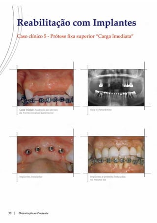 Guia orientacao implantes