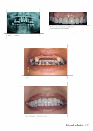 Guia orientacao implantes