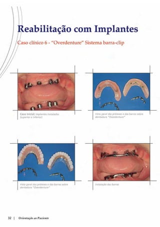 Guia orientacao implantes