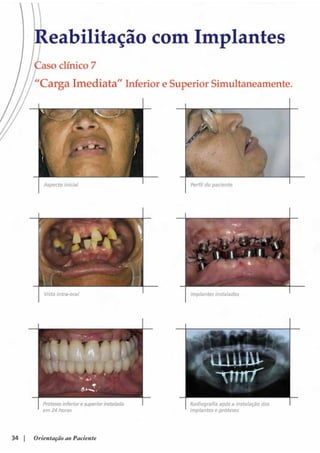 Guia orientacao implantes