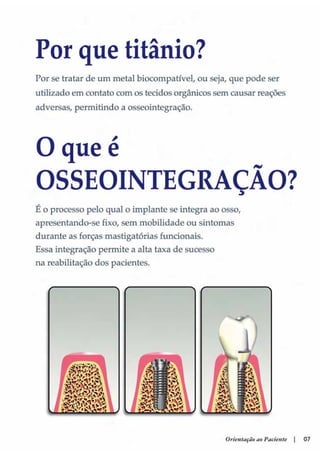 Guia orientacao implantes