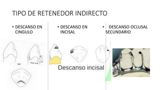 TIPO DE RETENEDOR INDIRECTO
• DESCANSO EN
CINGULO
• DESCANSO EN
INCISAL
• DESCANSO OCLUSAL
SECUNDARIO
 