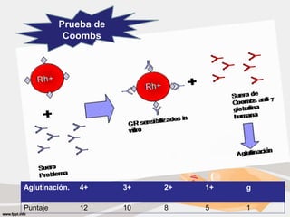 Prueba de 
Coombs 
Aglutinación. 4+ 3+ 2+ 1+ g 
Puntaje 12 10 8 5 1 
 