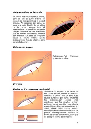 Sutura continua de Reverdín

Es similar a la sutura continua simple,
pero en ella el punto todavía no
tensado se hace pasar bajo el asa del
anterior. Al traccionar del último se
logra una mejor fijación de los labios
de la herida, aunque tiene el
inconveniente de que el hilo se puede
romper fácilmente en las inflexiones
que se forman contactando material
con material. En caso de desgarro
tisular la sutura restante queda
excesivamente floja. La utlizamos para
cerrar el abdomen.

Suturas con grapas



                                                Aplicaciones:Piel,   Vísceras(
                                                grapas especiales)




Eversión

Puntos en U o recurrente horizontal
                                      Su realización es como si se tratase de
                                      dos puntos simples, hechos en dirección
                                      contraria y unidos con un solo nudo
                                      (cuatro punciones por punto, anudando
                                      los    extremos).Son     puntos     mas
                                      resistentes que los simples, si bien
                                      producen mayor eversión y una cicatriz
                                      mas evidente. Son mas aconsejables en
                                      zonas donde haya mucha tensión
                                      (se desgarra menos el tejido que con los
                                      puntos simples).También dificulta el
                                      hecho de que se rompa el hilo, dado que
                                      no pasa por encima de la incisión.


                                                                            4
 
