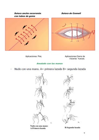 Sutura ancha recurrente                  Sutura de Connell
con tubos de goma




         Aplicaciones: PieL                  Aplicaciones:Cierre de
                                                  vísceras huecas.

                     Anudado con las manos




              Nudo con una mano:
              A:Primera lazada               B:Segunda lazada

                                                                 9
 