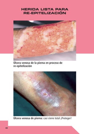 40
Úlcera venosa de la pierna en proceso de
re-epitelización
Úlcera venosa de pierna: casi cierre total ¡Proteger!
HERIDA LISTA PARA
RE-EPITELIZACIÓN
 