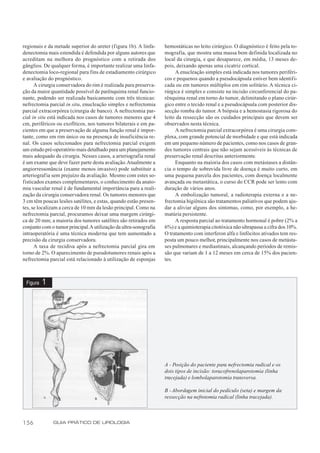 regionais e da metade superior do ureter (figura 1b). A linfa-    hemostáticas no leito cirúrgico. O diagnóstico é feito pela to-
denectomia mais estendida é defendida por alguns autores que      mografia, que mostra uma massa bem definida localizada no
acreditam na melhora do prognóstico com a retirada dos            local da cirurgia, e que desaparece, em média, 13 meses de-
gânglios. De qualquer forma, é importante realizar uma linfa-     pois, deixando apenas uma cicatriz cortical.
denectomia loco-regional para fins de estadiamento cirúrgico           A enucleação simples está indicada nos tumores periféri-
e avaliação do prognóstico.                                       cos e pequenos quando a pseudocápsula estiver bem identifi-
      A cirurgia conservadora do rim é realizada para preserva-   cada ou em tumores múltiplos em rim solitário. A técnica ci-
ção da maior quantidade possível de parênquima renal funcio-      rúrgica é simples e consiste na incisão circunferencial do pa-
nante, podendo ser realizada basicamente com três técnicas:       rênquima renal em torno do tumor, delimitando o plano cirúr-
nefrectomia parcial in situ, enucleação simples e nefrectomia     gico entre o tecido renal e a pseudocápsula com posterior dis-
parcial extracorpórea (cirurgia de banco). A nefrectomia par-     secção romba do tumor. A biópsia e a hemostasia rigorosa do
cial in situ está indicada nos casos de tumores menores que 4     leito da ressecção são os cuidados principais que devem ser
cm, periféricos ou exofíticos, nos tumores bilaterais e em pa-    observados nesta técnica.
cientes em que a preservação de alguma função renal é impor-           A nefrectomia parcial extracorpórea é uma cirurgia com-
tante, como em rim único ou na presença de insuficiência re-      plexa, com grande potencial de morbidade e que está indicada
nal. Os casos selecionados para nefrectomia parcial exigem        em um pequeno número de pacientes, como nos casos de gran-
um estudo pré-operatório mais detalhado para um planejamento      des tumores centrais que não sejam acessíveis às técnicas de
mais adequado da cirurgia. Nesses casos, a arteriografia renal    preservação renal descritas anteriormente.
é um exame que deve fazer parte desta avaliação. Atualmente a          Enquanto na maioria dos casos com metástases a distân-
angiorressonância (exame menos invasivo) pode substituir a        cia o tempo de sobrevida livre de doença é muito curto, em
arteriograf ia sem prejuízo da avaliação. Mesmo com estes so-     uma pequena parcela dos pacientes, com doença localmente
fisticados exames complementares, o conhecimento da anato-        avançada ou metastática, o curso do CCR pode ser lento com
mia vascular renal é de fundamental importância para a reali-     duração de vários anos.
zação da cirurgia conservadora renal. Os tumores menores que           A embolização tumoral, a radioterapia externa e a ne-
3 cm têm poucas lesões satélites, e estas, quando estão presen-   frectomia higiênica são tratamentos paliativos que podem aju-
tes, se localizam a cerca de 10 mm da lesão principal. Como na    dar a aliviar alguns dos sintomas, como, por exemplo, a he-
nefrectomia parcial, procuramos deixar uma margem cirúrgi-        matúria persistente.
ca de 20 mm; a maioria dos tumores satélites são retirados em          A resposta parcial ao tratamento hormonal é pobre (2% a
conjunto com o tumor principal.A utilização da ultra-sonografia   6%) e a quimioterapia citotóxica não ultrapassa a cifra dos 10%.
intraoperatória é uma técnica moderna que tem aumentado a         O tratamento com interferon alfa e linfócitos ativados tem res-
precisão da cirurgia conservadora.                                posta um pouco melhor, principalmente nos casos de metásta-
      A taxa de recidiva após a nefrectomia parcial gira em       ses pulmonares e mediastinais, alcançando períodos de remis-
torno de 2%. O aparecimento de pseudotumores renais após a        são que variam de 1 a 12 meses em cerca de 15% dos pacien-
nefrectomia parcial está relacionado à utilização de esponjas     tes.



 Figura   1




                                                                  A - Posição do paciente para nefrectomia radical e os
                                                                  dois tipos de incisão: toracofrenolaparotomia (linha
                                                                  tracejada) e lombolaparotomia transversa.

                                                                  B - Abordagem inicial do pedículo (seta) e margem da
                                                                  ressecção na nefrotomia radical (linha tracejada).



156           GUIA PRÁTICO DE UROLOGIA
 
