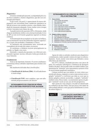 Diagnóstico                                                               ESTADIAMENTO DO CÂNCER DE PÊNIS
      A história relatada pelo paciente, acompanhada pelo exa-                   PELO SISTEMA TNM
me físico cuidadoso, orienta o diagnóstico, que deve ser con-
firmado pela biópsia.                                              T - Tumor primário
                                                                       Tx Tumor primário não-avaliado
      O que ocorre, em geral, é o aparecimento de massa sub-           T 0 Sem evidência de tumor
prepucial com crescimento lento, tratada por ignorância ou             T is Carcinoma in situ
falta de recursos com remédios caseiros, o que retarda a intro-        Ta Tumor verrucoso não-invasivo
dução do tratamento adequado. Assim, muitas vezes a terapia            T 1 Tumor invade tecido conectivo subepitelial
                                                                       T 2 Tumor invade corpo cavernoso ou esponjoso
correta é iniciada já sem chance de cura.                              T 3 Tumor invade uretra ou próstata
      A grande maioria dos pacientes (80%), felizmente, ainda          T 4 Tumor invade estruturas adjacentes
chega ao atendimento médico com a doença localizada. Cerca
de 20% já tem envolvimento ganglionar regional ou doença           N - Gânglios linfáticos regionais
                                                                       N x Linfonodos não-avaliados
sistêmica.                                                             N 0 Sem metástases em linfonodos
      A disseminação dessa neoplasia se faz pela via linfática,        N 1 Metástase única em linfonodo inguinal superficial
com acometimento inicial dos linfonodos inguinais superfici-           N 2 Metástases múltiplas ou bilaterais em linfonodos inguinais superficiais
ais, a seguir, dos profundos e finalmente os ilíacos.                  N 3 Metástases em linfonodos inguinais profundos ou ilíacos
      As metástases são extremamente raras, ocorrendo em           M - Metástases a distância
conseqüência da invasão dos corpos cavernosos.                         Mx Metástases não-avaliadas
      As metástases a distância ocorrem principalmente no              M0 Sem metástases a distãncia
pulmão, no fígado e nos ossos.                                         M1 Metástases a distância
      Entretanto, a maioria dos pacientes vai a óbito por com-
plicações regionais: necrose, infecção e lesões por erosão dos
vasos femorais.                                                        Apesar de todos os métodos modernos para diagnóstico
                                                                  e estadiamento, ainda é grande o número de super ou subesta-
                                                                  diamento. Assim, muitas vezes temos que formular a nossa
Estadiamento
                                                                  idéia básica de tratamento.
     Trata-se de importante elemento. O correto estadiamen-
                                                                       Em 1977, Cabanas, estudando pacientes com câncer de
to da doença oferece subsídios importantes para orientar o tra-
                                                                  pênis, fez avaliações radiológicas e anatômicas de drenagem
tamento.
                                                                  linfática do pênis, descrevendo então um nódulo linfático que
     São atualmente utilizadas duas classificações:
                                                                  denominou de “sentinela”, pois representaria o primeiro local
                                                                  de envolvimento ganglionar metastático.
      • Classificação de Jackson (1966) - foi utilizada duran-
                                                                       Cabanas mostrou que esse nódulo, às vezes, estava aco-
        te muito tempo.
                                                                  metido pela doença, enquanto os outros eram normais (seria o
                                                                  gânglio “sentinela”) e confirmou que todas as vezes que os
      • Classificação TNM - mais completa, e que vem subs-        demais gânglios estavam acometidos, o gânglio “sentinela”
        tituindo progressivamente a de Jackson.                   também estava. Desse modo, o acometimento apenas do gân-
                                                                  glio “sentinela” revela ser um caso de bom prognóstico.
                                                                       Sob o ponto de vista cirúrgico, ele pode ser identificado
     ESTADIAMENTO DO CÂNCER DE PÊNIS
                                                                  na confluência de duas linhas, uma que passa a dois dedos da
    PELO SISTEMA PROPOSTO POR JACKSON
                                                                  tuberosidade pubiana e outra que passa medialmente à crossa
                                                                  da safena (figura 1).


                                                                   Figura    1            LOCALIZAÇÃO ANATÔMICA DO
                                                                                            LINFONODO“SENTINELA”
                                                                                            DESCRITO POR CABANAS




                                                                                                             1 - Tuberoside pubiana
                                                                                                             2 - Crossa da safena
                                                                                                             3 - Linfonodo “sentinela”



204            GUIA PRÁTICO DE UROLOGIA
 