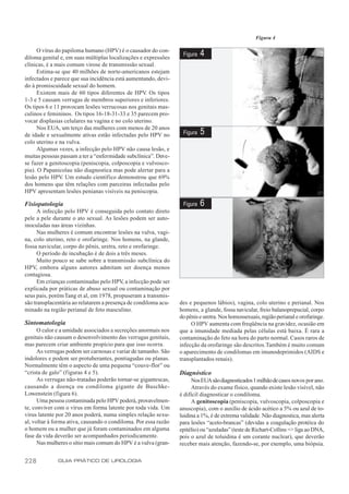 Figura 4

      O vírus do papiloma humano (HPV) é o causador do con-
diloma genital e, em suas múltiplas localizações e expressões
                                                                  Figura   4
clínicas, é a mais comum virose de transmissão sexual.
      Estima-se que 40 milhões de norte-americanos estejam
infectados e parece que sua incidência está aumentando, devi-
do à promiscuidade sexual do homem.
      Existem mais de 60 tipos diferentes de HPV. Os tipos
1-3 e 5 causam verrugas de membros superiores e inferiores.
Os tipos 6 e 11 provocam lesões verrucosas nos genitais mas-
culinos e femininos. Os tipos 16-18-31-33 e 35 parecem pro-
vocar displasias celulares na vagina e no colo uterino.
      Nos EUA, um terço das mulheres com menos de 20 anos
de idade e sexualmente ativas estão infectadas pelo HPV no        Figura   5
colo uterino e na vulva.
      Algumas vezes, a infecção pelo HPV não causa lesão, e
muitas pessoas passam a ter a “enfermidade subclínica”. Deve-
se fazer a genitoscopia (peniscopia, colposcopia e vulvosco-
pia). O Papanicolau não diagnostica mas pode alertar para a
lesão pelo HPV. Um estudo científico demonstrou que 69%
dos homens que têm relações com parceiras infectadas pelo
HPV apresentam lesões penianas visíveis na peniscopia.

Fisiopatologia                                                    Figura   6
      A infecção pelo HPV é conseguida pelo contato direto
pele a pele durante o ato sexual. As lesões podem ser auto-
inoculadas nas áreas vizinhas.
      Nas mulheres é comum encontrar lesões na vulva, vagi-
na, colo uterino, reto e orofaringe. Nos homens, na glande,
fossa navicular, corpo do pênis, uretra, reto e orofaringe.
      O período de incubação é de dois a três meses.
      Muito pouco se sabe sobre a transmissão subclínica do
HPV, embora alguns autores admitam ser doença menos
contagiosa.
      Em crianças contaminadas pelo HPV, a infecção pode ser
explicada por práticas de abuso sexual ou contaminação por
seus pais, porém Tang et al, em 1978, propuseram a transmis-
são transplacentária ao relatarem a presença de condiloma acu-   des e pequenos lábios), vagina, colo uterino e perianal. Nos
minado na região perianal de feto masculino.                     homens, a glande, fossa navicular, freio balanoprepucial, corpo
                                                                 do pênis e uretra. Nos homossexuais, região perianal e orofaringe.
Sintomatologia                                                        O HPV aumenta com freqüência na gravidez, ocasião em
      O calor e a umidade associados a secreções anormais nos    que a imunidade mediada pelas células está baixa. É rara a
genitais não causam o desenvolvimento das verrugas genitais,     contaminação do feto na hora do parto normal. Casos raros de
mas parecem criar ambiente propício para que isso ocorra.        infecção da orofaringe são descritos. Também é muito comum
      As verrugas podem ser carnosas e variar de tamanho. São    o aparecimento de condilomas em imunodeprimidos (AIDS e
indolores e podem ser protuberantes, pontiagudas ou planas.      transplantados renais).
Normalmente têm o aspecto de uma pequena “couve-flor” ou
“crista de galo” (f iguras 4 e 5).                               Diagnóstico
      As verrugas não-tratadas poderão tornar-se gigantescas,         Nos EUA são diagnosticados 1 milhão de casos novos por ano.
causando a doença ou condiloma gigante de Buschke-                    Através do exame físico, quando existe lesão visível, não
Lowenstein (figura 6).                                           é difícil diagnosticar o condiloma.
      Uma pessoa contaminada pelo HPV poderá, provavelmen-            A genitoscopia (peniscopia, vulvoscopia, colposcopia e
te, conviver com o vírus em forma latente por toda vida. Um      anuscopia), com o auxílio de ácido acético a 5% ou azul de to-
vírus latente por 20 anos poderá, numa simples relação sexu-     luidina a 1%, é de extrema validade. Não diagnostica, mas alerta
al, voltar à forma ativa, causando o condiloma. Por essa razão   para lesões “aceto-brancas” (devidas a coagulação protéica do
o homem ou a mulher que já foram contaminados em alguma          epitélio) ou “azuladas” (teste de Richart-Collins => liga ao DNA,
fase da vida deverão ser acompanhados periodicamente.            pois o azul de toluidina é um corante nuclear), que deverão
      Nas mulheres o sítio mais comum do HPV é a vulva (gran-    receber mais atenção, fazendo-se, por exemplo, uma biópsia.


228           GUIA PRÁTICO DE UROLOGIA
 