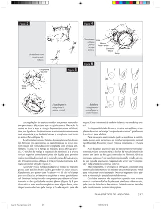 Figura    3                                                       Figura   4


                                                                            Cistostomia
                                                                                oblíqua
                                                                                  para a
                                                                                 bexiga
                                                                                 psóica.
                         Reimplante com
                            técnica anti-
                                 refluxo.
                                                                             Figura   6
                                                               Figura   5




                                             Fixação para o                        Retalho e
                                             reimplante e                      alongamento
                                             sutura vesical.                  vesical para o
                                                                               ureter médio.



               As angulações do ureter causadas por pontos hemostáti-       migrar. Uma cistostomia é também deixada, ou uma Foley ure-
         cos próximos a ele podem ser corrigidas com a liberação do         tral.
         ureter na área, e aqui a cirurgia laparoscópica tem utilidade;           Na impossibilidade de usar a técnica anti-refluxo, o im-
         mas, nas ligaduras, freqüentemente a ureteroureteroanastomose      plante do ureter na bexiga “em punho-de-camisa” geralmente
         será necessária, e, se bastante baixas, o reimplante com técni-    é aceitável para adultos.
         ca anti-refluxo (figura 3).                                              Para alcançar o ureter médio pode-se combinar a mobili-
               Lesões mais extensas, fístulas, desvascularizações do ure-   zação psóica com as técnicas de retalho/alongamento vesical
         ter, fibroses pós-operatórias ou radioterápicas no terço infe-     tipo Boari (a), Passerini-Glazel (b) ou a zetaplastia (c) (figura
         rior podem ser corrigidas pelo reimplante com técnica anti-        6).
         refluxo, fixando-se a bexiga ao músculo psoas (bexiga psói-              Não devemos esquecer que as transureteroureteroanas-
         ca). O fundus da bexiga é separado do peritônio, e a artéria       tomoses podem ser úteis para as lesões da metade inferior do
         vesical superior contralateral pode ser ligada para permitir       ureter, em casos de bexigas contraídas ou fibroses pélvicas
         maior mobilidade vesical até o músculo psoas do lado deseja-       intensas e extensas. Um túnel retroperitoneal é criado, deven-
         do. Uma cistostomia oblíqua é feita perpendicularmente à di-       do ser evitada angulação exagerada do ureter ou “compres-
         reção do ureter afetado (figura 4).                                são” pela artéria mesentérica inferior.
               A cúpula vesical é direcionada para o tendão do músculo            Mais raramente, o urologista é obrigado a realizar uma
         psoas, com auxílio de dois dedos, por sobre os vasos ilíacos.      ureterocalicoanastomose ou mesmo um autotransplante renal
         Geralmente, três pontos com fio absorvível 00 são suficientes      para solucionar lesões ureterais. O uso de segmento ileal per-
         para sua fixação, evitando-se englobar o nervo genitofemu-         mite a substituição parcial ou total do ureter.
         ral. O ureter é reimplantado com pontos que o fixem suficien-            Cuidados maiores são requeridos quando num trauma
         temente e a bexiga fechada em dois planos (figura 5). É pru-       ureteral coexistem lesões do pâncreas, duodeno, cólon ou reto,
         dente deixar uma sonda nasogástrica com alguns furos, sain-        pelo risco de deiscência das suturas. Estas devem ser isoladas
         do por contra-abertura pela bexiga e fixada na pele, para não      pelo envolvimento protetor do epíplon.

                                                                                           GUIA PRÁTICO DE UROLOGIA                    247


Cap 42- Trauma Ureteral.pm6           247                                                    13/06/00, 15:12
 