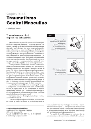 Capítulo 45
Traumatismo
Genital Masculino
Luiz Edison Slongo



Traumatismo superficial                                                Figura   1
do pênis e da bolsa escrotal
                                                                                A) Pênis estrangulado
                                                                          por um anel com importante
      Os traumatismos do pênis e da bolsa escrotal são infreqüen-                        edema distal.
tes devido a sua grande mobilidade e localização protegida. En-                  O pênis é envolto por
tretanto, a perda de tecido de revestimento da genitália pode estar            um barbante resistente,
associada a uma lesão maior com severo comprometimento dos                         no sentido cranial,
órgãos subjacentes. As causas mais freqüentes das lesões trau-              múltiplas vezes até o anel.
máticas genitais são os ferimentos penetrantes por arma branca
ou de fogo. O objetivo principal do tratamento é manter a função
erétil e, na medida do possível, a preservação das gônadas. Ob-
servamos com freqüência lesões menores, tais como o aprisiona-
mento da pele genital pelo zíper das calças, situação que por ve-
zes requer anestesia e o rompimento da barra mediana do corpo
do zíper com cisalha ortopédica ou até mesmo a postectomia.
      Estrangulamentos acidentais são relatados durante a mas-
turbação com objetos ao redor do pênis (ex.: anel metálico).
Esses estrangulamentos podem levar à isquemia e necrose do                      B) O edema é removido
órgão. Tais objetos são removidos com auxílio de sedação e                            cranialmente e o
lubrificantes. Quando há um volumoso edema distal à cons-                           barbante é passado
trição e a pele for viável, um fio de algodão (barbante) pode                        por baixo do anel.
ser aplicado a partir da glande envolvendo-se o pênis no sen-
tido proximal circunferencialmente, quantas vezes se fizer ne-
cessário até o anel constritor, liberando-o assim do edema (f i-
gura 1). Entretanto, em casos especiais há necessidade de ins-
trumentos mecânicos para a secção do objeto constritor.
      A súbita flexão ventral do pênis em ereção pode romper
o seu ligamento suspensor. O paciente refere um estalo e dor
na base do órgão, sendo ou não acompanhado de pequeno
hematoma em contraste com a fratura do corpo cavernoso. A
correção cirúrgica está indicada para proporcionar estabilida-
de ao órgão durante o intercurso sexual.                                        C) O anel é retirado.
      Ferimentos menores são simplesmente limpos e sutura-
dos com fio absorvível.
      A avulsão da pele do pênis ou da bolsa escrotal ocorre
em vítimas de ataques de animais ou em situações em que as

                                                                      vestes são fortemente tracionadas por maquinarias e em aci-
                                                                      dentes automotivos (foto 1). A reaproximação dos bordos da
Endereço para correspondência:                                        pele deve ser sempre tentada. Quando há perda do tegumento
Rua Portugal, 329 - Bairro São Francisco                              ou inviabilidade do mesmo, faz-se necessário um enxerto de
80510-280 - Curitiba-PR                                               pele parcial (pedir auxílio à cirurgia plástica).
Tel.: (0--41) 324-1329/224-1347 - Fax: (0--41) 224-8823                    Por ocasião da avulsão da pele do pênis, convém re-
E-mail: slongo-uro@mps.com.br                                         mover-se o tecido dérmico restante distal à lesão, evitando-

                                                                                    GUIA PRÁTICO DE UROLOGIA                 257
 