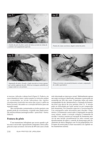 Foto   1                                                            Foto   2




  Avulsão da pele do pênis e parte da bolsa escrotal em vítima de
                                                                      Fratura do corpo cavernoso, ângulo ventral do pênis.
  acidente com equipamento agrícola.




 Foto   3                                                            Foto   4




  Amputação do pênis, ficando o órgão inserido ao tronco apenas       Vítima de tortura com grande ferimento cortante e amputação
  por estreito segmento de pele. Observar torniquete embebido em      do cordão espermático.
  sangue atado ao coto peniano.




se necrose, infecção e edema local (figura 2). Todavia, em          está relacionada ao intercurso sexual. Habitualmente apenas
casos dramáticos tanto o pênis quanto os testículos podem           um corpo cavernoso é danificado, entretanto a uretra pode ser
ser acomodados no tecido subcutâneo das regiões                     acometida em 20% dos casos. O paciente refere um estalo
circunjacentes (testículos nas raízes das coxas e o pênis na        acompanhado de dor, detumescência e formação de hemato-
bolsa escrotal), deixando-se a correção definitiva para um          ma local com desvio do eixo peniano (foto 2). A micção
segundo tempo.                                                      pode ser dificultada por lesão uretral ou por compressão
     São consideradas contaminadas as lesões genitais com           pelo hematoma. Em situações especiais a cavernosografia
grande perda de revestimento, exigindo uma ampla prote-             e/ou uretrografia serão necessárias para elucidar o diag-
ção antimicrobiana (aminoglicosídeo + penicilina + metro-           nóstico. O tratamento conservador é empregado em apenas
nidazol).                                                           casos seletos, sendo a correção cirúrgica o tratamento de
                                                                    escolha. A técnica consiste na evacuação do hematoma atra-
Fratura do pênis                                                    vés de uma incisão circunferencial no sulco coronal com
                                                                    desenluvamento do pênis e controle da hemorragia pelo fe-
     É um traumatismo infreqüente que ocorre quando o pê-           chamento da túnica albugínea com f io de polipropileno 4-0.
nis ereto é encurvado vigorosamente rompendo a túnica albu-         O reparo da uretra pode se fazer necessário (ver capítulo so-
gínea do corpo cavernoso. Em torno de 40% dos casos a lesão         bre traumatismo uretral).


258            GUIA PRÁTICO DE UROLOGIA
 