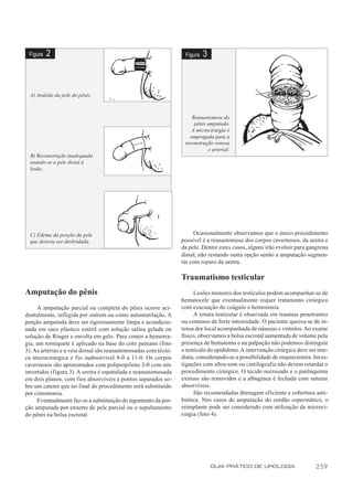 Figura   2                                                       Figura   3



  A) Avulsão da pele do pênis.



                                                                     Reanastomose do
                                                                      pênis amputado.
                                                                     A microcirurgia é
                                                                    empregada para a
                                                                  reconstrução venosa
                                                                            e arterial.
  B) Reconstrução inadequada
  usando-se a pele distal à
  lesão.




  C) Edema da porção da pele                                          Ocasionalmente observamos que o único procedimento
  que deveria ser desbridada.                                    possível é a reanastomose dos corpos cavernosos, da uretra e
                                                                 da pele. Dentre estes casos, alguns irão evoluir para gangrena
                                                                 distal, não restando outra opção senão a amputação segmen-
                                                                 tar com reparo da uretra.

                                                                 Traumatismo testicular
Amputação do pênis                                                     Lesões menores dos testículos podem acompanhar-se de
                                                                 hematocele que eventualmente requer tratamento cirúrgico
     A amputação parcial ou completa do pênis ocorre aci-        com evacuação do coágulo e hemostasia.
dentalmente, infligida por outrem ou como automutilação. A             A rotura testicular é observada em traumas penetrantes
porção amputada deve ser rigorosamente limpa e acondicio-        ou contusos de forte intensidade. O paciente queixa-se de in-
nada em saco plástico estéril com solução salina gelada ou       tensa dor local acompanhada de náuseas e vômitos. Ao exame
solução de Ringer e envolta em gelo. Para conter a hemorra-      físico, observamos a bolsa escrotal aumentada de volume pela
gia, um torniquete é aplicado na base do coto peniano (foto      presença de hematoma e na palpação não podemos distinguir
3). As artérias e a veia dorsal são reanastomosadas com técni-   o testículo do epidídimo. A intervenção cirúrgica deve ser ime-
ca microcirúrgica e fio inabsorvível 8-0 a 11-0. Os corpos       diata, considerando-se a possibilidade de orquiectomia. Inves-
cavernosos são aproximados com polipropileno 3-0 com nós         tigações com ultra-som ou cintilografia não devem retardar o
invertidos (figura 3). A uretra é espatulada e reanastomosada    procedimento cirúrgico. O tecido necrosado e o parênquima
em dois planos, com fios absorvíveis e pontos separados so-      extruso são removidos e a albugínea é fechada com suturas
bre um cateter que no final do procedimento será substituído     absorvíveis.
por cistostomia.                                                       São recomendadas drenagem eficiente e cobertura anti-
     Eventualmente faz-se a substituição do tegumento da por-    biótica. Nos casos de amputação do cordão espermático, o
ção amputada por enxerto de pele parcial ou o sepultamento       reimplante pode ser considerado com utilização da microci-
do pênis na bolsa escrotal.                                      rurgia (foto 4).




                                                                               GUIA PRÁTICO DE UROLOGIA                   259
 