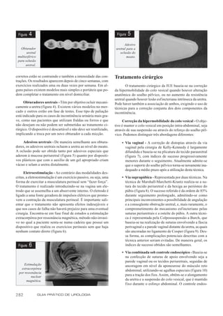 Figura   4                                                         Figura   5
                                                                          Adesivo
   Obturador                                                        uretral para a
       uretral                                                         oclusão do
 multiesférico                                                              meato.
 para oclusão
       uretral.


corretos estão se contraindo e também a intensidade das con-       Tratamento cirúrgico
trações. Os resultados aparecem depois de cinco semanas, com
exercícios realizados uma ou duas vezes por semana. Em al-                 O tratamento cirúrgico da IUE baseia-se na correção
guns países existem modelos mais simples e portáteis que po-       da hipermobilidade do colo vesical quando houver alteração
dem completar o tratamento em nível domiciliar.                    anatômica do soalho pélvico, ou no aumento da resistência
                                                                   uretral quando houver lesão esfincteriana intrínseca da uretra.
      Obturadores uretrais - Têm por objetivo ocluir mecani-       Pode haver também a associação de ambos, exigindo o uso de
camente a uretra (figura 4). Existem vários modelos no mer-        técnicas para a correção conjunta dos dois componentes da
cado e outros estão em fase de testes. Esse tipo de paliação       incontinência.
está indicado para os casos de incontinência urinária mais gra-
ve, como nas pacientes que utilizam fraldas ou forros e que             Correção da hipermobilidade do colo vesical - O obje-
não desejam ou não podem ser submetidas ao tratamento ci-          tivo é manter o colo vesical em posição intra-abdominal, seja
rúrgico. O dispositivo é descartável e não deve ser reutilizado,   através de sua suspensão ou através do reforço do soalho pél-
implicando a troca por um novo obturador a cada micção.            vico. Podemos distinguir três abordagens diferentes:
     Adesivos uretrais - De maneira semelhante aos obtura-              • Via vaginal - A correção de distopias através da via
dores, os adesivos uretrais ocluem a uretra ao nível do meato.            vaginal pela cirurgia de Kelly-Kennedy é largamente
A oclusão pode ser obtida tanto por adesivos especiais que                difundida e baseia-se na plicatura do tecido parauretral
aderem à mucosa periuretral (figura 5) quanto por dispositi-              (f igura 7), com índices de sucesso progressivamente
vos plásticos que com o auxílio de um gel apropriado criam                menores durante o seguimento. Atualmente admite-se
vácuo e selam a uretra distalmente.                                       que o suporte do soalho pélvico torna-se novamente ina-
                                                                          dequado a médio prazo após a utilização desta técnica.
      Eletroestimulação - Ao contrário das modalidades des-
critas, a eletroestimulação é um exercício passivo, ou seja, uma        • Via suprapúbica - Representada por duas técnicas. Na
forma de exercitar a musculatura perineal sem “fazer força”.              técnica de Marshall-Marchetti-Krantz realiza-se a su-
O tratamento é realizado introduzindo-se na vagina um ele-                tura do tecido periuretral e da bexiga ao periósteo do
trodo que se assemelha a um absorvente interno. O eletrodo é              púbis (figura 8). O sucesso referido é da ordem de 85%
ligado a uma fonte geradora de impulsos elétricos que promo-              durante seguimento prolongado, admitindo-se como
vem a contração da musculatura perineal. É importante sali-               principais inconvenientes a possibilidade de angulação
entar que o tratamento não apresenta efeitos indesejáveis e               e a conseqüente obstrução uretral, e, mais raramente, o
que nos casos de falha não haverá prejuízo para uma eventual              comprometimento do mecanismo esfincteriano pelas
cirurgia. Encontra-se em fase final de estudos a estimulação              suturas periuretrais e a osteíte do púbis. A outra técni-
extracorpórea por ressonância magnética, método não-invasi-               ca é representada pela Colpossuspensão a Burch, que
vo no qual a paciente senta-se numa cadeira que possui um                 baseia-se na realização de suturas envolvendo a fáscia
dispositivo que realiza os exercícios perineais sem que haja              perivaginal e a parede vaginal distante da uretra, as quais
nenhum contato direto (figura 6).                                         são ancoradas no ligamento de Cooper (figura 9). Des-
                                                                          sa forma, as complicações potenciais descritas com a
                                                                          técnica anterior seriam evitadas. De maneira geral, os
 Figura   6                                                               índices de sucesso obtidos são semelhantes.

                                                                        • Via combinada sob controle endoscópico - Baseia-se
                                                                          na confecção de suturas de apoio envolvendo seja a
                                                                          parede vaginal ou os tecidos periuretrais, seguidas de
     Estimulação                                                          ancoragem em nível da aponeurose do músculo reto
    extracorpórea
                                                                          abdominal, utilizando-se agulhas especiais (figura 10)
  por ressonância
          nuclear                                                         para a tração dos fios. Assim, obtêm-se o alongamento
       magnética.                                                         da uretra e a suspensão do colo vesical, que é mantido
                                                                          fixo durante o esforço abdominal. O controle endos-

282               GUIA PRÁTICO DE UROLOGIA
 