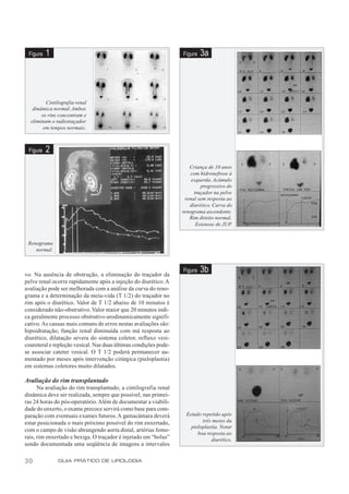 Figura   1                                                       Figura   3a




         Cintilografia renal
   dinâmica normal. Ambos
       os rins concentram e
  eliminam o radiotraçador
        em tempos normais.



 Figura   2
                                                                     Criança de 10 anos
                                                                     com hidronefrose à
                                                                      esquerda. Acúmulo
                                                                          progressivo do
                                                                       traçador na pelve
                                                                   renal sem resposta ao
                                                                     diurético. Curva do
                                                                  renograma ascendente.
                                                                     Rim direito normal.
                                                                        Estenose de JUP.


 Renograma
    normal.



vo. Na ausência de obstrução, a eliminação do traçador da
                                                                  Figura   3b
pelve renal ocorre rapidamente após a injeção do diurético. A
avaliação pode ser melhorada com a análise da curva do reno-
grama e a determinação da meia-vida (T 1/2) do traçador no
rim após o diurético. Valor de T 1/2 abaixo de 10 minutos é
considerado não-obstrutivo. Valor maior que 20 minutos indi-
ca geralmente processo obstrutivo urodinamicamente signifi-
cativo. As causas mais comuns de erros nestas avaliações são:
hipoidratação, função renal diminuída com má resposta ao
diurético, dilatação severa do sistema coletor, refluxo vesi-
coureteral e repleção vesical. Nas duas últimas condições pode-
se associar cateter vesical. O T 1/2 poderá permanecer au-
mentado por meses após intervenção cirúrgica (pieloplastia)
em sistemas coletores muito dilatados.

Avaliação do rim transplantado
      Na avaliação do rim transplantado, a cintilografia renal
dinâmica deve ser realizada, sempre que possível, nas primei-
ras 24 horas do pós-operatório. Além de documentar a viabili-
dade do enxerto, o exame precoce servirá como base para com-
paração com eventuais exames futuros. A gamacâmara deverá          Estudo repetido após
estar posicionada o mais próximo possível do rim enxertado,               três meses da
                                                                     pieloplastia. Notar
com o campo de visão abrangendo aorta distal, artérias femo-
                                                                        boa resposta ao
rais, rim enxertado e bexiga. O traçador é injetado em “bolus”                diurético.
sendo documentada uma seqüência de imagens a intervalos

30            GUIA PRÁTICO DE UROLOGIA
 