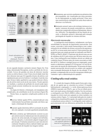 n hematomas, que ocorrem usualmente nos primeiros dias
 Figura   4a                                                              pós-transplante, são visualizados por áreas persisten-
                                                                          tes de hipocaptação na região perirrenal. Estas mes-
                                                                          mas características cintilográficas serão observadas no
                                                                          abscesso e na linfocele;
  Enxerto na
  fossa ilíaca
    direita. O                                                          n obstrução ureteral, tanto as de etiologia intrínseca (co-
    estudo do                                                             águlos, estenoses da junção ureteropélvica, cálculos)
  fluxograma                                                              quanto por compressão extrínseca (hematomas, absces-
   revela boa                                                             sos, linfocele). Na dependência de boa função do en-
    perfusão.                                                             xerto, a obstrução ureteral é detectada pela retenção
                                                                          prolongada do traçador no sistema caliciano.

 Figura   4b                                                       Hipertensão renovascular
                                                                        A cintilografia renal dinâmica, isoladamente, tem baixa
                                                                   sensibilidade na detecção da hipertensão renovascular. Este
                                                                   exame, associado à intervenção farmacológica com a admi-
                                                                   nistração de um inibidor da enzima conversora da angiotensi-
                                                                   na (ECA), se torna muito mais sensível. Vários protocolos são
                                                                   propostos para este estudo que pode ser realizado com 99mTc-
                                                                   DTPA ou 99mTc-MAG3. O paciente não deverá estar em uso
  Estudo subseqüente com
            boa captação e
                                                                   de inibidores da ECA pelo menos por 48 horas antes dos exa-
     eliminação. Nota-se o                                         mes. Uma cintilografia renal dinâmica deverá ser obtida em
  trajeto da sonda vesical.                                        condições basais 24 horas antes do exame associado ao inibi-
                                                                   dor da ECA. Embora o enalapril possa ser empregado, usual-
                                                                   mente se administra captopril (25-50 mg) por via oral 60 mi-
                                                                   nutos antes da injeção do radiotraçador. Na presença de hiper-
de um segundo durante o primeiro minuto (figura 4a). Esta          tensão renovascular, deverá ocorrer no estudo com captopril
etapa, denominada fluxograma, avalia a perfusão do rim en-         uma acentuada diminuição da função do rim afetado. É im-
xertado. Curvas são geradas em áreas de interesse vascular         portante a comparação das curvas dos renogramas obtidos pre-
(aorta ou artéria ilíaca) e renal. O pico da atividade renal não   viamente e após a administração de captopril.
deve demorar mais que 4-6 segundos do pico da artéria e cair
rapidamente para um nível inferior. A avaliação visual das ima-
gens fornece dados qualitativos que podem detectar obstru-
                                                                   Cintilografia renal estática
ção da artéria renal ou de um de seus ramos. No pós-operató-
                                                                        É o estudo das imagens obtidas quatro horas após a inje-
rio imediato, a ausência de perfusão do enxerto pode repre-
                                                                   ção de um agente que se concentra na cortical. O traçador
sentar oclusão arterial, trombose da veia renal ou rejeição hi-
                                                                   habitualmente empregado é o ácido dimercaptossuccínico
peraguda.
                                                                   (DMSA) marcado com 99mTc, que se fixa no túbulo proxi-
     As etapas de trânsito e eliminação, em transplantes não-
                                                                   mal e tem muito pouca eliminação urinária. Em rins normais,
complicados, são semelhantes às de rins normais (figura 4b).
                                                                   a cintilografia com 99mTc-DMSA reflete a distribuição do
     Nestas fases, as seguintes complicações podem ser de-
                                                                   traçador no córtex renal sem captação no córtex medular e no
tectadas:
                                                                   sistema coletor (figura. 5). A principal indicação do estudo é
                                                                   o diagnóstico da pielonefrite aguda e da seqüela (cicatriz) que
     n necrose tubular aguda (NTA), caracterizada por uma
                                                                   eventualmente possa sobrevir. A cintilografia renal estática é
       relativamente boa perfusão associada com baixa cap-
                                                                   particularmente útil em diferenciar pielonefrite da infecção
       tação e eliminação do traçador;

     n rejeição aguda determina déficit acentuado da perfu-         Figura   5
       são com captação e excreção igualmente prejudicadas;

     n fístulas urinárias que habitualmente ocorrem na jun-
       ção ureterovesical se traduzem por área de acúmulo pro-
       gressivo de urina marcada, de margens mal definidas.             Cintilografia estática com
       Nessas situações, é conveniente adquirir imagens pré e       99mTc-DMSA. Aspecto normal
       pós-micção. O urinoma caracteriza-se por uma área ini-          com captação uniforme do
       cialmente fotopênica (baixa radioatividade) que apre-           material no parênquima de
                                                                                    ambos os rins.
       senta acúmulo de traçador nas imagens tardias;

                                                                                 GUIA PRÁTICO DE UROLOGIA                      31
 