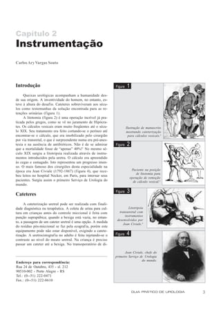 Capítulo 2
Instrumentação
Carlos Ary Vargas Souto




Introdução                                                      Figura   1
     Queixas urológicas acompanham a humanidade des-
de sua origem. A inventividade do homem, no entanto, es-
teve à altura do desafio. Cateteres sobreviveram aos sécu-
los como testemunhas da solução encontrada para as re-
tenções urinárias (figura 1).
     A litotomia (figura 2) é uma operação incrível já pra-
ticada pelos gregos, como se vê no juramento de Hipócra-
tes. Os cálculos vesicais eram muito freqüentes até o sécu-              Ilustração de manuscrito
lo XIX. Seu tratamento era feito cortando-se o períneo até               mostrando cateterização
encontrar-se o cálculo, que era imobilizado pelo cirurgião                 para cálculos vesicais.2
por via transretal, o que é surpreendente numa era pré-anes-
tesia e na ausência de antibióticos. Não é de se admirar        Figura   2
que a mortalidade fosse de “apenas” 40%!1 No mesmo sé-
culo XIX surgiu a litotripsia realizada através de instru-
mentos introduzidos pela uretra. O cálculo era apreendido
às cegas e esmagado. Isto representou um progresso imen-
so. O mais famoso dos cirurgiões desta especialidade na
época era Jean Civiale (1792-1867) (figura 4), que rece-                      Paciente na posição
                                                                                 de litotomia para
beu leitos no hospital Necker, em Paris, para internar seus
                                                                             operação de remoção
pacientes. Surgiu assim o primeiro Serviço de Urologia do                      de cálculo vesical.3
mundo.
                                                                Figura   3
Cateteres
      A cateterização uretral pode ser realizada com finali-
dade diagnóstica ou terapêutica. A coleta de urina para cul-             Litotripsia
tura em crianças antes do controle miccional é feita com          transuretral com
punção suprapúbica; quando a bexiga está vazia, no entan-             instrumentos
                                                                 desenvolvidos por
to, a passagem de um cateter uretral é uma opção. A medida
                                                                     Jean Civiale. 4
do resíduo pós-miccional se faz pela ecografia, porém este
equipamento pode não estar disponível, exigindo a catete-
rização. A uretrocistografia no adulto é feita injetando-se o   Figura   4
contraste ao nível do meato uretral. Na criança é preciso
passar um cateter até a bexiga. No transoperatório de di-

                                                                       Jean Civiale, chefe do
                                                                primeiro Serviço de Urologia
                                                                                  do mundo.
Endereço para correspondência:
Rua 24 de Outubro, 435 - sl. 212
90510-002 - Porto Alegre - RS
Tel.: (0--51) 222-0471
Fax.: (0--51) 222-8610


                                                                              GUIA PRÁTICO DE UROLOGIA   3
 