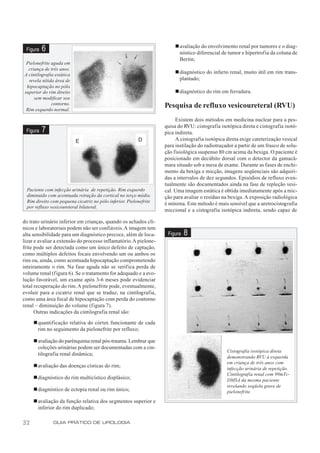 n avaliação do envolvimento renal por tumores e o diag-
 Figura   6                                                               nóstico diferencial de tumor e hipertrofia da coluna de
                                                                          Bertin;
 Pielonefrite aguda em
  criança de três anos.
A cintilografia estática
                                                                        n diagnóstico do infarto renal, muito útil em rim trans-
  revela nítida área de                                                   plantado;
 hipocaptação no pólo
superior do rim direito                                                 n diagnóstico do rim em ferradura.
     sem modificar seu
              contorno.                                             Pesquisa de refluxo vesicoureteral (RVU)
 Rim esquerdo normal.

                                                                         Existem dois métodos em medicina nuclear para a pes-
                                                                    quisa do RVU: cistografia isotópica direta e cistografia isotó-
 Figura   7                                                         pica indireta.
                           E                              D              A cistografia isotópica direta exige cateterização vesical
                                                                    para instilação do radiotraçador a partir de um frasco de solu-
                                                                    ção fisiológica suspenso 80 cm acima da bexiga. O paciente é
                                                                    posicionado em decúbito dorsal com o detector da gamacâ-
                                                                    mara situado sob a mesa de exame. Durante as fases de enchi-
                                                                    mento da bexiga e micção, imagens seqüenciais são adquiri-
                                                                    das a intervalos de dez segundos. Episódios de refluxo even-
                                                                    tualmente são documentados ainda na fase de repleção vesi-
  Paciente com infecção urinária de repetição. Rim esquerdo         cal. Uma imagem estática é obtida imediatamente após a mic-
  diminuído com acentuada retração da cortical no terço médio.      ção para avaliar o resíduo na bexiga. A exposição radiológica
  Rim direito com pequena cicatriz no pólo inferior. Pielonefrite   é mínima. Este método é mais sensível que a uretrocistografia
  por refluxo vesicoureteral bilateral.
                                                                    miccional e a cistografia isotópica indireta, sendo capaz de

do trato urinário inferior em crianças, quando os achados clí-
nicos e laboratoriais podem não ser confiáveis. A imagem tem
alta sensibilidade para um diagnóstico precoce, além de loca-        Figura   8
lizar e avaliar a extensão do processo inflamatório. A pielone-
frite pode ser detectada como um único defeito de captação,
como múltiplos defeitos focais envolvendo um ou ambos os
rins ou, ainda, como acentuada hipocaptação comprometendo
inteiramente o rim. Na fase aguda não se verifica perda de
volume renal (figura 6). Se o tratamento for adequado e a evo-
lução favorável, um exame após 3-6 meses pode evidenciar
total recuperação do rim. A pielonefrite pode, eventualmente,
evoluir para a cicatriz renal que se traduz, na cintilografia,
como uma área focal de hipocaptação com perda do contorno
renal – diminuição do volume (figura 7).
      Outras indicações da cintilografia renal são:

     n quantificação relativa do córtex funcionante de cada
       rim no seguimento da pielonefrite por refluxo;

     n avaliação do parênquima renal pós-trauma. Lembrar que
       coleções urinárias podem ser documentadas com a cin-
                                                                                                 Cistografia isotópica direta
       tilografia renal dinâmica;
                                                                                                 demonstrando RVU à esquerda
                                                                                                 em criança de três anos com
     n avaliação das doenças císticas do rim;                                                    infecção urinária de repetição.
                                                                                                 Cintilografia renal com 99mTc-
     n diagnóstico do rim multicístico displásico;                                               DMSA da mesma paciente
                                                                                                 revelando seqüela grave de
     n diagnóstico de ectopia renal ou rim único;                                                pielonefrite.
     n avaliação da função relativa dos segmentos superior e
       inferior do rim duplicado;

32             GUIA PRÁTICO DE UROLOGIA
 