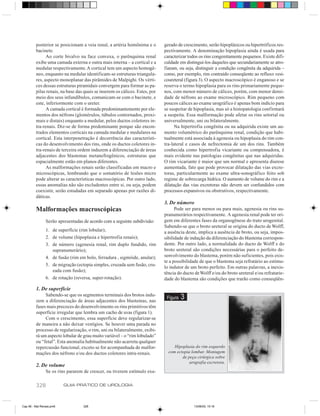 posterior se posicionam a veia renal, a artéria homônima e o        gerado de crescimento, serão hipoplásicos ou hipertróficos res-
         bacinete.                                                           pectivamente. A denominação hipoplasia ainda é usada para
               Ao corte bivalvo na face convexa, o parênquima renal          caracterizar todos os rins congenitamente pequenos. Existe difi-
         exibe uma camada externa e outra mais interna – a cortical e a      culdade em distingui-los daqueles que secundariamente se atro-
         medular respectivamente. A cortical tem um aspecto homogê-          fiaram, ou seja, distinguir a condição congênita da adquirida –
         neo, enquanto na medular identificam-se estruturas triangula-       como, por exemplo, rim contraído conseqüente ao refluxo vesi-
         res, aspecto monoplanar das pirâmides de Malpighi. Os vérti-        coureteral (figura 3). O aspecto macroscópico é enganoso e se
         ces dessas estruturas piramidais convergem para formar as pa-       reserva o termo hipoplasia para os rins primariamente peque-
         pilas renais, na base das quais se inserem os cálices. Estes, por   nos, com menor número de cálices, porém, com menor densi-
         meio dos seus infundíbulos, comunicam-se com o bacinete, e          dade de néfrons ao exame microscópico. Rim pequeno com
         este, inferiormente com o ureter.                                   poucos cálices ao exame urográfico é apenas bom indício para
               A camada cortical é formada predominantemente por ele-        se suspeitar de hipoplasia, mas só a histopatologia confirmará
         mentos dos néfrons (glomérulos, túbulos contornados, proxi-         a suspeita. Essa malformação pode afetar os rins setorial ou
         mais e distais) enquanto a medular, pelos ductos coletores in-      universalmente, uni ou bilateralmente.
         tra-renais. Diz-se de forma predominante porque são encon-                Na hipertrofia congênita ou na adquirida existe um au-
         trados elementos corticais na camada medular e medulares na         mento volumétrico do parênquima renal, condição que habi-
         cortical. Esta interpenetração é decorrência das característi-      tualmente está associada à agenesia ou hipoplasia do rim con-
         cas do desenvolvimento dos rins, onde os ductos coletores in-       tra-lateral e casos de nefrectomia de um dos rins. Também
         tra-renais de terceira ordem induzem a diferenciação de áreas       conhecida como hipertrofia vicariante ou compensadora, é
         adjacentes dos blastemas metanefrogênicos, estruturas que           mais evidente nas patologias congênitas que nas adquiridas.
         espacialmente estão em planos diferentes.                           O rim vicariante é maior que um normal e apresenta diurese
               As malformações renais serão classificadas em macro e         aumentada, fato que pode provocar dilatação das vias excre-
         microscópicas, lembrando que o somatório de lesões micro            toras, particularmente ao exame ultra-sonográfico feito sob
         pode alterar as características macroscópicas. Por outro lado,      regime de sobrecarga hídrica. O aumento de volume do rim e a
         essas anomalias não são excludentes entre si, ou seja, podem        dilatação das vias excretoras não devem ser confundidos com
         coexistir, serão estudadas em separado apenas por razões di-        processos expansivos ou obstrutivos, respectivamente.
         dáticas.
                                                                             3. De número
         Malformações macroscópicas                                                Pode ser para menos ou para mais, agenesia ou rins su-
                                                                             pranumerários respectivamente. A agenesia renal pode ter ori-
                Serão apresentadas de acordo com a seguinte subdivisão:      gem em diferentes fases da organogênese do trato urogenital.
                                                                             Sabendo-se que o broto ureteral se origina do ducto de Wolff,
                1. de superfície (rim lobular);                              a ausência deste, implica a ausência de broto, ou seja, impos-
                2. de volume (hipoplasia e hipertrofia renais);              sibilidade de indução da diferenciação do blastema correspon-
                3. de número (agenesia renal, rim duplo fundido, rim         dente. Por outro lado, a normalidade do ducto de Wolff e do
                   supranumerário);                                          broto ureteral são condições necessárias para o perfeito de-
                4. de fusão (rim em bolo, ferradura , sigmóide, anular);     senvolvimento do blastema, porém não suficientes, pois exis-
                                                                             te a possibilidade de que o blastema seja refratário ao estímu-
                5. de migração (ectopia simples, cruzada sem fusão, cru-
                                                                             lo indutor de um broto perfeito. Em outras palavras, a inexis-
                   zada com fusão);
                                                                             tência do ducto de Wolff e/ou do broto ureteral e/ou refratarie-
                6. de rotação (reversa, super-rotação).                      dade do blastema são condições que trarão como conseqüên-

         1. De superfície
              Sabendo-se que os segmentos terminais dos brotos indu-
         zem a diferenciação de áreas adjacentes dos blastemas, nas
                                                                              Figura   3
         fases mais precoces do desenvolvimento os rins primitivos têm
         superfície irregular que lembra um cacho de uvas (figura 1).
              Com o crescimento, essa superfície deve regularizar-se
         de maneira a não deixar vestígios. Se houver uma parada no
         processo de regularização, o rim, uni ou bilateralmente, exibi-
         rá um aspecto lobular de grau muito variável – o “rim lobulado”
         ou “fetal”. Esta anomalia habitualmente não acarreta qualquer
         repercussão funcional, exceto se for acompanhada de malfor-              Hipoplasia do rim esquerdo
         mações dos néfrons e/ou dos ductos coletores intra-renais.            com ectopia lombar. Montagem
                                                                                      de peça cirúrgica sobre
                                                                                          urografia excretora.
         2. De volume
                Se os rins pararem de crescer, ou tiverem estímulo exa-

         328              GUIA PRÁTICO DE UROLOGIA



Cap 56 - Mal Renais.pm6            328                                                       13/06/00, 15:16
 