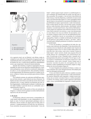 fusão”, exibem aspecto muito variável e as malformações re-
           Figura    4                                                     nais resultantes são identificadas de acordo com algo que se
                                                                           lhes assemelhe. Por exemplo, o rim em bolo é decorrência da
                                                                           fusão maciça e total dos blastemas, resultando em massa renal
                                                                           única com forma discóide (figura 5). Como conseqüência deste
                                                                           tipo de fusão os rins primitivos encontram dificuldade ou im-
                                                                           possibilidade de migrar superiormente e rodar internamente.
                                                                           Estes eventos fazem com que o rim em bolo ocupe a posição
                                                                           pélvica, tenha bacinetes anteriorizados, distribuição calicial
                                                                           aleatória e vascularização bizarra. Suas artérias habitualmen-
                                                                           te têm origem nos segmentos mais inferiores da aorta e/ou dos
                                                                           vasos ilíacos internos e/ou externos, e suas veias drenam para
           A
                                                                           os vasos ilíacos e/ou veia cava inferior. Se necessárias, as in-
                                                                           tervenções cirúrgicas sobre esses rins são habitualmente deli-
                                                                           cadas e, idealmente devem ser precedidas de avaliação
                                                                           angiográfica. Impõe-se cuidado na indicação de nefrectomias
                                                                           de rins pélvicos, pois podem ser únicos, “em bolo”, onde a
                                                                           vascularização múltipla geralmente inviabiliza a tentativa de
                                                                           revascularização.
               Esquemas:                                                        O rim em ferradura é conseqüência da fusão dos seg-
                                                                           mentos mais inferiores dos blastemas. Como decorrência ha-
               A - Rim supranumerário.                                     verá desvio do eixo bipolar de cada unidade renal. O ponto de
               B - Rim duplo fundido.                                      convergência destes eixos se situa na linha média abaixo do
                                                                           nível dos rins e não acima, como seria o normal. O grau de
                                          B                                fusão renal é muito variável, desde uma pequena faixa de
                                                                           tecido fibroso até o parênquima com características nor-
                                                                           mais. O tecido que os une é chamado istmo, e quando este é
         cia a agenesia renal, uni ou bilateral, esta última, ainda in-    parenquimatoso há cálices nessa região. Via de regra os cáli-
         compatível com sobrevida. O diagnóstico da agenesia pode ser      ces situam-se medialmente aos bacinetes respectivos e não
         suspeitado pelo ultra-som gestacional e, quando bilateral, além   lateralmente, como seria o normal. Assim, sempre que se
         da ausência de rins, o exame deverá identificar oligoidrâmnio     encontrar inversão do ponto de convergência dos eixos
         severo, que compromete o desenvolvimento pulmonar.                bipolares e cálices medialmente aos bacinetes, impõe-se o diag-
               Quando não satisfeita a exigência organogênica da con-      nóstico de rim em ferradura (figura 6).
         tinuidade de cada um dos blastemas metanefrogênicos, resul-            É a mais freqüente das anomalias de fusão e o istmo e os
         tarão parênquimas renais definitivos totalmente independen-       vasos anômalos não criam obrigatoriamente dificuldade para
         tes entre si, os rins supranumerários. São anomalias resultan-    uma boa drenagem pieloureteral.
         tes da fragmentação dos blastemas primitivos e podem ser tó-           O rim com fusão dos pólos inferiores também encontra
         picos, ectópicos e drenar suas secreções para ureteres bífidos    dificuldade para migrar superiormente e rodar internamente.
         ou duplos.                                                        Os maiores obstáculos para migração e rotação nessas ano-
               Em condições normais, de cada ducto de Wolff nasce ape-     malias são os tirantes vasculares ilíacos e a artéria mesentéri-
         nas um broto ureteral, o qual induzirá um único blastema. Na      ca inferior. No entanto, tendo os pólos superiores individuali-
         hipótese de haver dois brotos nascendo do mesmo ducto (mais       zados, existe a possibilidade de migração e rotação parciais,
         raramente três), os quais induzem um blastema que não so-
         freu fragmentação, a malformação resultante é conhecida como
         rim duplo fundido o qual não deverá ser confundido com o           Figura   5
         supranumerário (figura 4).
               A distinção entre os dois pode ser feita com métodos de
         imagem e o volume total de qualquer um deles habitualmente
         equivale ao de um rim normal.

         4. De fusão
              Os blastemas, além de conservarem a continuidade, de-
         verão manter individualidade, ou seja, independência em re-
         lação ao outro. Se houver aproximação patológica entre os
         blastemas, deverá resultar em algum grau de fusão entre os                      Rim em bolo.
         mesmos, e comprometimento da forma dos rins definitivos.
         Essas anomalias são genericamente denominadas “vícios de

                                                                                         GUIA PRÁTICO DE UROLOGIA                    329


Cap 56 - Mal Renais.pm6             329                                                    13/06/00, 15:16
 