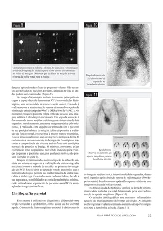 Figura   9                                                         Figura   10




Cistografia isotópica indireta. Menina de seis anos com infecção
urinária de repetição. Refluxo para o rim direito documentado
no início da micção. Observar que ao final da micção a urina
                                                                    Torção de testículo.
retorna da pelve renal para a bexiga.
                                                                     Há decréscimo de
                                                                           captação na
                                                                     hemibolsa direita.
detectar episódios de refluxo de pequeno volume. Não neces-
sita cooperação do paciente, portanto, crianças de toda as ida-
des podem ser examinadas (figura 8).                                Figura   11
      A cistografia isotópica indireta tem como principal van-
tagem a capacidade de demonstrar RVU em condições fisio-
lógicas, sem necessidade de cateterização vesical. O estudo é
realizado com a administração venosa de um radiotraçador de
eliminação urinária rápida (99mTc-DTPA/99mTc-MAG3). No
momento em que o paciente refere repleção vesical, uma ima-
gem estática é obtida (pré-miccional). Em seguida a micção é
documentada numa seqüência de imagens a intervalos de dois
segundos. Imediatamente, uma nova imagem estática (pós-mic-
cional) é realizada. Esta seqüência é efetuada com o paciente
na sua posição habitual de micção. Além de permitir a avalia-
ção da função renal, esta técnica é muito menos traumática,
física e emocionalmente, que a cistografia isotópica direta. O
enchimento e o esvaziamento da bexiga são fisiológicos, tes-
tando a competência do sistema anti-refluxo sob condições
normais de pressão na bexiga. O método, entretanto, exige
cooperação total do paciente, não sendo indicado para crian-                    Epididimite.
ças pequenas e pacientes que, por qualquer motivo, não pos-           Observa-se aumento do
sam cooperar (f igura 9).                                            aporte sangüíneo para a
      Grupos experimentados na investigação da infecção uri-               hemibolsa direita.
nária em crianças sugerem a realização da uretrocistografia
miccional como o método de escolha na primeira investiga-
ção do RVU. Isto se deve ao apurado estudo anatômico que o
método radiológico permite nas malformações da uretra mas-
                                                                   de imagens seqüenciais, a intervalos de dois segundos, duran-
culina e da bexiga. Os estudos com radionuclídeos, devido a
                                                                   te 60 segundos após a injeção venosa do radiotraçador (99mTc-
sua segurança, sensibilidade e exposição radiológica mínima,
                                                                   pertecnetato). Imediatamente após o fluxograma obtém-se uma
estão indicados no seguimento de pacientes com RVU e avali-
                                                                   imagem estática da bolsa escrotal.
ação da cirurgia anti-refluxo.
                                                                         Na torção aguda do testículo, verifica-se área de hiporra-
                                                                   dioatividade na bolsa escrotal determinada pela severa dimi-
Cintilografia escrotal                                             nuição de aporte sangüíneo (f igura 10).
                                                                         Os achados cintilográficos nos processos inflamatórios
     Este exame é utilizado no diagnóstico diferencial entre       agudos são marcadamente diferentes da torção. As imagens
torção testicular e epididimite, como causa da dor escrotal        do fluxograma revelam acentuado aumento de aporte sangüí-
aguda. O estudo do fluxo sangüíneo escrotal é obtido através       neo para a hemibolsa afetada (figura 11).

                                                                               GUIA PRÁTICO DE UROLOGIA                        33
 