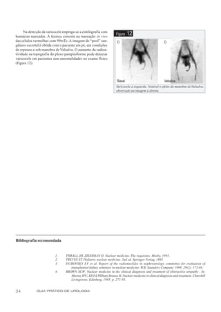 Na detecção da varicocele emprega-se a cintilografia com
hemácias marcadas. A técnica consiste na marcação in vivo
                                                                      Figura   12
das células vermelhas com 99mTc. A imagem do “pool” san-               D                                   D
güíneo escrotal é obtida com o paciente em pé, em condições
de repouso e sob manobra de Valsalva. O aumento da radioa-
tividade na topografia do plexo pampiniforme pode detectar
varicocele em pacientes sem anormalidades no exame físico
(figura 12).



                                                                       Basal                               Valsalva
                                                                      Varicocele à esquerda. Notável o efeito da manobra de Valsalva,
                                                                      observado na imagem à direita.




Bibliografia recomendada


                          1.     THRALL JH, ZIESSMAN H. Nuclear medicine. The requisites. Mosby, 1995.
                          2.     TREVES ST. Pediatric nuclear medicine. 2nd ed. Springer-Verlag, 1995.
                          3.     DUBOVSKY EV et al. Report of the radionuclides in nephrourology committee for evaluation of
                                    transplanted kidney seminars in nuclear medicine. W.B. Saunders Company 1999; 29(2): 175-88.
                          4.     BROWN SCW. Nuclear medicine in the clinical diagnosis and treatment of obstructive uropathy . In:
                                    Murray IPC, Ell PJ, William Strauss H. Nuclear medicine in clinical diagnosis and treatment. Churchill
                                    Livingstone, Edinburg, 1995; p. 271-93.


34            GUIA PRÁTICO DE UROLOGIA
 