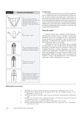 Complicações
 Figura   11      TÉCNICA DE KOYANAGY
                                                                          As complicações mais comuns são as fístulas uretrocutâ-
                                                                    neas e a estenose da uretra. Os estreitamentos do calibre ure-
                            A-                                      tral, em geral, ocorrem na transição entre a uretra nativa e a
                            Após a circuncisão subcoronal,          neo-uretra ou no meato uretral. As fístulas ocorrem entre 2%
                            dissecção do prepúcio até a base do     e 30%, dependendo da extensão da neo-uretra e a técnica uti-
                            pênis, exérese do “chordee” e           lizada. A correção das fístulas deve ser preferencialmente pos-
                            retificação peniana, desenham-se
                            dois “flaps” de pele distais ao meato   tergada para os seis meses após a cirurgia inicial, quando já
                            uretral.                                aconteceu a estabilização de todo o processo cicatricial, com
                                                                    neovascularização dos tecidos.

                                                                    Nota do autor
                            B-                                           É preciso reiterar que o presente capítulo fornece o
                            Os dois “flaps” isolados.               embasamento necessário para a avaliação e preparo pré-
                                                                    operatório, bem como os cuidados no trans e pós-operató-
                                                                    rio dos pacientes com hipospádia. Foge aos objetivos da
                                                                    publicação o detalhamento das múltiplas alternativas téc-
                                                                    nicas disponíveis para a sua correção.
                                                                         A descrição de mais de 300 técnicas para a correção
                            C-                                      das hipospádias em suas variadas formas de apresentação
                            Após a clivagem ampla da glande,        demonstra a constante busca de alternativas ideais, com
                            os “flaps” são unidos por sutura na     resultados funcionais e estéticos adequados e com índices
                            linha média e suturados à glande.
                                                                    aceitáveis de complicações. O domínio da cirurgia recons-
                                                                    trutiva da hipospádia é um dos exercícios técnicos mais
                                                                    especializados dentro da Urologia. Aliás, recentemente foi
                                                                    cunhado o termo “hipospadiologista” para denominar
                                                                    aquele que se dedica intensamente a esta área.

                            D-
                            A sutura dos bordos laterais
                            tubulariza a neo-uretra.




                            E-
                            Após a cobertura da neo-uretra com
                            tecido subcutâneo de prepúcio
                            dorsal ou com túnica vaginal de um
                            testículo para evitar a formação de
                            fístulas, procede-se à plástica do
                            pênis.




Bibliografia recomendada

                       1.       DAVID RR. In: Gonzales ET, Bauer SB. Pediatric urology practice. Philadelphia, 1999; 487-98.
                       2.       DUCKETT JW In: Walsh PC, Retik AB, Vaughan ED Jr., Wein AJ. Campbell’s Urology. 7th ed.,
                                             .
                                   Philadelphia, 1998; 2093-119.
                       3.       ERLICH A. Reconstructive and plastic surgery of the external genitalia: adult and pediatric. Philadelphia,
                                   1999.
                       4.       KEATING MA, DUCKETT JW. In: Whitfield HN, Hendry WF Kirby RS, Duckett JW. Textbook of
                                                                                                  ,
                                   genitourinary surgery. 2nd ed. Oxford, 1998; 319-36.
                       5.       KING LR. Urologic surgery in infants and children. Philadelphia, 1998; 194-208.
                       6.       RETIK AB, BAUER SB, MANDELL J et al. Management of severe hypospadias with a 2 stage repair. J
                                   Urol 1994; 152: 749-51.


356            GUIA PRÁTICO DE UROLOGIA
 