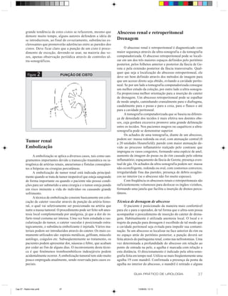 grande tendência de estes cistos se refazerem, mesmo que         Abscesso renal e retroperitoneal
          demore muito tempo, alguns autores defendem a idéia de
          se introduzirem, ao final do esvaziamento, substâncias es-       Drenagem
          clerosantes que promoverão aderências entre as paredes dos
          cistos. Deve ficar claro que a punção de um cisto é proce-            O abscesso renal e retroperitoneal é diagnosticado com
          dimento de exceção, devendo-se usar, na maioria das ve-          maior segurança através da ultra-sonografia e da tomografia
          zes, apenas observação periódica através de controles ul-        computadorizada. O abscesso retroperitoneal pode se locali-
          tra-sonográficos.                                                zar em um dos três maiores espaços definidos pelo peritônio
                                                                           posterior, pelos folhetos anterior e posterior da fáscia de Ge-
                                                                           rota e pela extensão posterior da fáscia transversalis. Qual-
                                                                           quer que seja a localização do abscesso retroperitoneal, ele
            Figura    2            PUNÇÃO DE CISTO
                                                                           deve ser bem definido através dos métodos de imagem para
                                                                           que um acesso direto seja obtido, evitando a cavidade perito-
                                                                           neal. Se por um lado a tomografia computadorizada consegue
                                                                           um melhor estudo da coleção, por outro lado a ultra-sonogra-
                                                                           fia proporciona melhor orientação para a inserção do cateter
                                                                           de drenagem. Um abscesso retroperitoneal pode se espalhar
                                                                           de modo amplo, caminhando cranialmente para o diafragma,
                                                                           caudalmente para o psoas e para a coxa, para o flanco e até
                                                                           para a cavidade peritoneal.
                                                                                A tomografia computadorizada que se baseia na diferen-
                                                                           ça de densidade dos tecidos é mais efetiva nos doentes obe-
                                                                           sos, cuja gordura excessiva promove uma grande delineação
                                                                           entre os tecidos. Nos pacientes magros ou caquéticos a ultra-
                                                                           sonografia pode se demonstrar superior.
                                                                                Os achados de uma tomografia, diante de um abscesso,
                                                                           podem ser: massa redonda ou oval, com atenuação central (0
          Tumor renal                                                      a 20 unidades Hounsfield); parede com maior atenuação de-
          Embolização                                                      vido ao processo inflamatório realçado pelo contraste que
                                                                           impregna os vasos congestos, formando uma espécie de anel;
                A embolização se aplica a diversos casos, tais como san-   aumento da imagem do psoas ou do rim causado pelo edema
          gramentos importantes devido a transecção traumática ou ia-      inflamatório; espaçamento da fáscia de Gerota; presença even-
          trogênica de artérias renais, aneurismas e fístulas conseqüen-   tual de gás. Os achados da ultra-sonografia podem ser: massa
          tes a biópsias ou cirurgias percutâneas.                         não-ecorefrigente, redonda ou oval, com contornos convexos;
                A embolização de tumor renal está indicada principal-      irregularidade fina das paredes; presença de debris ecogêni-
          mente quando se trata de tumor inoperável que esteja sangrando   cos no interior (se o abscesso não for muito espesso).
          de forma importante ou quando o paciente não possui condi-            Com freqüência os abscessos renais e retroperitoneais são
          ções para ser submetido a uma cirurgia e o tumor esteja pondo    suficientemente volumosos para deslocar os órgãos vizinhos,
          em risco iminente a vida do indivíduo ou causando grande         formando uma janela que facilita a inserção de drenos percu-
          sofrimento.                                                      tâneos.
                A técnica de embolização consiste basicamente em colo-
          cação de cateter vascular através de punção da artéria femo-     Técnica de drenagem de abscesso
          ral, o qual vai seletivamente ser posicionado na artéria que           O paciente é posicionado da maneira mais confortável
          nutre a massa tumoral. O procedimento pode ser feito sob anes-   para ele e para o operador, de tal forma que o ultra-som possa
          tesia local complementada por analgesia, já que a dor do in-     acompanhar o procedimento de inserção do cateter de drena-
          farto renal costuma ser intensa. Uma vez bem estudada a vas-     gem. Habitualmente é utilizada anestesia local. O local e o
          cularização do tumor, o cateter vascular é posicionado estra-    trajeto da punção para drenagem é escolhido de tal modo que
          tegicamente, e substância embolizante é injetada. Vários ma-     a cavidade peritoneal seja evitada para impedir sua contami-
          teriais podem ser introduzidos através do cateter. Os mais co-   nação. Se um abscesso se localizar na face anterior do rim ou
          mumente utilizados são: espirais metálicas, gelfoam, músculo     no espaço atrás do peritônio posterior, a punção deverá ser
          autólogo, coágulos etc. Subseqüentemente ao tratamento, os       feita através do parênquima renal, como nas nefrostomias. Uma
          pacientes podem apresentar dor, náuseas e febre, que acabam      vez determinada a profundidade do abscesso em relação ao
          por ceder ao fim de alguns dias. O inconveniente desta técni-    ponto de entrada na pele, a agulha é marcada com relação a
          ca é que fenômenos tromboembólicos indesejáveis podem            esta distância. O direcionamento é indicado pela ultra-sono-
          acidentalmente ocorrer. A embolização tumoral tem sido muito     grafia feita em tempo real. Utiliza-se mais freqüentemente uma
          pouco empregada atualmente, sendo reservada para casos es-       agulha 19 com mandril. Confirmada a presença da ponta da
          peciais.                                                         agulha no interior do abscesso, o mandril é retirado e alguns

                                                                                       GUIA PRÁTICO DE UROLOGIA                       37


Cap 07 - Radio-Inter.pm6          37                                                      13/06/00, 13:13
 
