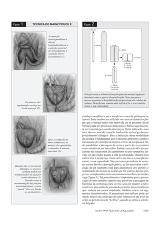 Figura   1         TÉCNICA DO MAINZ POUCH II             Figura   2

                               A transição
                               retossigmoidiana é
                               aberta
                               longitudinalmente e
                               a parede posterior
                               do retossigmóide é
                               suturada látero-
                               lateralmente (1).




                                                          Relação entre o volume alcançado para um mesmo segmento
                                                          intestinal antes e após a destubulização. Note que para o
                                                          mesmo segmento a destubulização proporciona até o dobro do
          Os ureteres são                                 volume. Desta forma, quanto mais esférico for o reservatório,
   implantados na alça na                                 maior a sua capacidade.
       borda superior (2).


                                                        patologia neoplásica, por exemplo em casos de patologias tu-
                                                        morais. Pode também ser utilizada em casos de desderivações
                                                        em que a bexiga tenha sido removida ou se encontre de tal
                                                        forma lesada por processos infecciosos e fibrose que necessi-
                                                        te ser removida por ocasião da cirurgia. Outra indicação, mais
                                                        rara, são os casos de remoção inadvertida da bexiga durante
                                                        procedimento cirúrgico. Para a indicação desta modalidade
                               Após a confecção de      de cirurgia é fundamental que o paciente apresente a uretra e
                               túnel submucoso, os      mecanismo de continência íntegros e livres de neoplasia a fim
                               meatos são espatulados   de possibilitar a drenagem da urina a partir do reservatório
                               e suturados à mucosa     com continência nos intervalos. Embora cerca de 80% dos pa-
                               intestinal (3).          cientes não necessitem de cateterismo no pós-operatório de-
                                                        vem ser advertidos quanto a esta possibilidade. Quanto mais
                                                        esférica for a neobexiga, maior será o seu raio e, conseqüente-
                                                        mente, a sua capacidade. Nos pacientes portadores de urete-
                                                        res curtos devido a derivação prévia, se faz necessária a utili-
 Quando não se encontram
      dilatados, os ureteres                            zação de um segmento ileal para anastomose dos ureteres e
         também podem ser                               implantação do mesmo na neobexiga. Os ureteres devem sem-
 reimplantados na alça por                              pre ser reimplantados com mecanismo anti-refluxo na neobe-
       contra-abertura (4).                             xiga (figura 3). Tal procedimento é importante para a preser-
           Visando evitar a                             vação do trato urinário superior seja por evitar a passagem de
 movimentação das junções                               bactérias da neobexiga para os rins seja por manter a pelve
  ureterointestinais, o novo                            renal livre das ondas de pressão decorrentes do peristaltismo
   “pouch” deve ser fixado                              que, embora em menor amplitude, também ocorre em seg-
           ao promontório.
                                                        mentos destubulizados. O mecanismo anti-refluxo pode ser
                                                        obtido através da confecção de túnel submucoso em nível do
                                                        cólon ou pela técnica de “Le Duc”, quando se utiliza o intesti-
                                                        no delgado.

                                                                      GUIA PRÁTICO DE UROLOGIA                     189
 