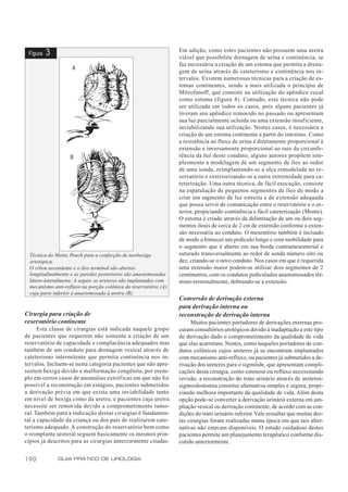 Em adição, como estes pacientes não possuem uma uretra
 Figura   3                                                        viável que possibilite drenagem de urina e continência, se
                                                                   faz necessária a criação de um estoma que permita a drena-
                                                                   gem de urina através de cateterismo e continência nos in-
                                                                   tervalos. Existem numerosas técnicas para a criação de es-
                                                                   tomas continentes, sendo a mais utilizada o princípio de
                                                                   Mitrofanoff, que consiste na utilização do apêndice cecal
                                                                   como estoma (figura 4). Contudo, esta técnica não pode
                                                                   ser utilizada em todos os casos, pois alguns pacientes já
                                                                   tiveram seu apêndice removido no passado ou apresentam
                                                                   sua luz parcialmente ocluída ou uma extensão insuficiente,
                                                                   inviabilizando sua utilização. Nestes casos, é necessária a
                                                                   criação de um estoma continente a partir do intestino. Como
                                                                   a resistência ao fluxo de urina é diretamente proporcional à
                                                                   extensão e inversamente proporcional ao raio da circunfe-
                                                                   rência da luz deste conduto, alguns autores propõem sim-
                                                                   plesmente a modelagem de um segmento de íleo ao redor
                                                                   de uma sonda, reimplantando-se a alça remodelada no re-
                                                                   servatório e exteriorizando-se a outra extremidade para ca-
                                                                   teterização. Uma outra técnica, de fácil execução, consiste
                                                                   na espatulação de pequenos segmentos de íleo de modo a
                                                                   criar um segmento de luz estreita e de extensão adequada
                                                                   que possa servir de comunicação entre o reservatório e o ex-
                                                                   terior, propiciando continência e fácil cateterização (Monte).
                                                                   O estoma é criado através da delimitação de um ou dois seg-
                                                                   mentos ileais de cerca de 2 cm de extensão conforme a exten-
                                                                   são necessária ao conduto. O mesentério também é incisado
                                                                   de modo a fornecer um pedículo longo e com mobilidade para
                                                                   o segmento que é aberto em sua borda contramesenterial e
  Técnica do Mainz Pouch para a confecção de neobexiga             suturado transversalmente ao redor de sonda número oito ou
  ortotópica.                                                      dez, criando-se o novo conduto. Nos casos em que é requerida
  O cólon ascendente e o íleo terminal são abertos                 uma extensão maior podem-se utilizar dois segmentos de 2
  longitudinalmente e as paredes posteriores são anastomosadas     centímetros, com os condutos pediculados anastomosados tér-
  látero-lateralmente. A seguir, os ureteres são implantados com   mino-terminalmente, dobrando-se a extensão.
  mecanismo anti-refluxo na porção colônica do reservatório (A),
  cuja parte inferior é anastomosada à uretra (B).
                                                                   Conversão de derivação externa
                                                                   para derivação interna ou
Cirurgia para criação de                                           reconstrução de derivação interna
reservatório continente                                                 Muitos pacientes portadores de derivações externas pro-
      Esta classe de cirurgias está indicada naquele grupo         curam consultórios urológicos devido à inadaptação a este tipo
de pacientes que requerem não somente a criação de um              de derivação dado o comprometimento da qualidade de vida
reser vatório de capacidade e complacência adequados mas           que elas acarretam. Nestes, como naqueles portadores de con-
também de um conduto para drenagem vesical através de              dutos colônicos cujos ureteres já se encontram implantados
cateterismo intermitente que permita continência nos in-           com mecanismo anti-refluxo, ou pacientes já submetidos a de-
tervalos. Incluem-se nesta categoria pacientes que não apre-       rivação dos ureteres para o sigmóide, que apresentam compli-
sentem bexiga devido a malformação congênita, por exem-            cações desta cirurgia, como estenose ou refluxo necessitando
plo em certos casos de anomalias extróficas em que não foi         revisão, a reconstrução do trato urinário através de ureteros-
possível a reconstrução em estágios, pacientes submetidos          sigmoidostomia constitui alternativa simples e segura, propi-
a derivação prévia em que exista uma inviabilidade tanto           ciando melhora importante da qualidade de vida. Além desta
em nível de bexiga como da uretra, e pacientes cuja uretra         opção pode-se converter a derivação urinária externa em am-
necessite ser removida devido a comprometimento tumo-              pliação vesical ou derivação continente, de acordo com as con-
ral. Também para a indicação destas cirurgias é fundamen-          dições do trato urinário inferior. Vale ressaltar que muitas des-
tal a capacidade da criança ou dos pais de realizarem cate-        tas cirurgias foram realizadas numa época em que tais alter-
terismo adequado. A construção do reservatório bem como            nativas não estavam disponíveis. O estudo cuidadoso destes
o reimplante ureteral seguem basicamente os mesmos prin-           pacientes permite um planejamento terapêutico conforme dis-
cípios já descritos para as cirurgias anteriormente citadas.       cutido anteriormente.


190           GUIA PRÁTICO DE UROLOGIA
 