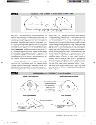 Figura    1                      COLOCAÇÃO DO CURSOR PARA MEDIDAS DA PRÓSTATA




                                       Equação para calcular o volume prostático pela fórmula do elipsóide:
                                                         L x A x C x ∏/6 = L x A x C x 0, 52


          lantes orais e antiinflamatórios não-esteróides deve ser         lubrificação. Este é avançado cranialmente, até a altura das
          suspenso antecipadamente. No caso de cumarínicos, que não        vesículas seminais, onde inicia-se o exame, no sentido trans-
          puderem ser interrompidos, o paciente deve ser internado e o     versal (coronal). Neste ponto pode-se proceder com as medi-
          medicamento trocado para heparina EV a qual é descontinuada
                                                  ,                        das do volume (figura 1). Esquadrinha-se toda a próstata, da
          quatro horas antes do exame e reiniciada quatro horas após.      base até o ápice, avaliando-se a ecogenicidade das diferentes
          Se o paciente não necessita de nenhuma cobertura antibiótica     regiões e a integridade da cápsula. Após, passa-se ao plano
          especial, pode-se realizar a profilaxia com uma quinolona do     sagital, rotando o transdutor (no caso de “end-fire”) cerca de
          tipo ciprofloxacina, 500 mg, uma hora antes do exame, sendo      90º . Examina-se a próstata realizando-se movimentos látero-
          mantida, no mínimo, por mais duas doses, duas vezes ao dia.      laterais, tipo leque, observando os diferentes detalhes desde o
          Se o paciente possui valvulopatia ou prótese valvular, a anti-   ângulo próstato-seminal até o ápice. O examinador deve estar
          bioticoterapia profilática para endocardite é imperativa. No     absolutamente familiarizado com a anatomia prostática des-
          caso de prótese ortopédica, recomenda-se aumentar a dose da      crita por McNeal e popularizada por Lee et al. (figura 2). As
          quinolona para 750 mg. A aspirina e os antiinflamatórios po-     lesões são melhor localizadas no plano coronal, embora as
          dem, em geral, ser reiniciados 3-4 dias após.                    biópsias sejam realizadas no plano sagital. A agulha é com-
                                                                           posta de duas partes que deslizam entre si: uma bainha exter-
               Técnica - A posição usual é o decúbito lateral esquerdo.    na e uma agulha interna. A incursão total da agulha é de cerca
          Procede-se com a realização do toque retal (TR) para avaliar     de 2,3 a 2,4 cm, sendo que sua ponta mede 0,5 cm, é sólida e
          o grau de limpeza e familiarizar o examinador com as anor-       não obtém tecido. A calha de biópsia vem a seguir, com exten-
          malidades palpáveis presentes. O transdutor, previamente co-     são total de 1,7 cm (1,5 cm em sua base), conforme demons-
          berto com um preservativo é então inserido, lentamente, após     trado na figura 3.


            Figura    2                         ANATOMIA PROSTÁTICA TRANSVERSAL E SAGITAL




                                                                                       GUIA PRÁTICO DE UROLOGIA                       21


Cap 04 - Ultra-sonografia.pm6     21                                                      13/06/00, 13:10
 