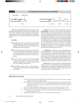 Figura    3                                   EXTREMIDADE DISTAL DA AGULHA DE BIÓPSIA




               Quando são realizadas biópsias aleatórias, devemos obter                   Aspectos - Em cerca de 70% das neoplasias o aspecto é
          pelo menos três fragmentos de cada lobo, das regiões da base,              hipoecogênico e em cerca de 30% isoecóico, sendo raramen-
          meio e ápice. Glândulas maiores que 40 cm3, provavelmente,                 te hiperecogênico ou com calcificações, tipo “céu estrelado”.
          necessitam de um maior número de fragmentos. A presença de                 Existem situações, principalmente tumores mais avançados,
          nódulos palpáveis ou visíveis ao se efetuar a US exige amostras            que podem exibir mais de um dos aspectos descritos acima.
          extras.                                                                    Outro detalhe importante do exame é o aspecto da cápsula
                                                                                     verdadeira, no que diz respeito a sua continuidade/integrida-
                 Anatomia:                                                           de e abaulamentos. Estes podem ser sinais de penetração ou
                                                                                     extensão extracapsular. O câncer da ZT pode ser mais difícil
                 n Zona Periférica (ZP) – Compreende cerca de 70% do                 de ser diagnosticado em meio a presença de nódulos
                   tecido glandular, preenchendo as partes posteriores da            hiperplásicos. Devemos, neste local, observar assimetrias e
                   glândula e parte das laterais; 70% das neoplasias se              heterogenicidade suspeita. A ZT é uma região normalmente
                   originam aqui, além de prostatite.                                um pouco mais hipoecóica que a ZP e ZC.

                 n Zona de Transição (ZT) – Representa cerca de 5% a                      Complicações - Atualmente, com o uso de pistolas auto-
                   10% do tecido glandular, originalmente, localizando-              máticas e quinolonas, o índice de complicações é baixo. Estas,
                   se anteriormente à ZP, à direita e à esquerda da ure-             tipicamente limitam-se a infecções e hemorragias com coágu-
                   tra. É sede de HBP e cerca de 20% a 25% das neo-                  los, mais sérios em cerca de 1% a 2% dos casos. Por vezes
                   plasias.                                                          pode haver hematúria macroscópica mais prolongada, sem ou-
                                                                                     tras conseqüências, e hemospermia. Sangramentos mais im-
                 n Zona Central (ZC) – Possui cerca de 25% de glândula               portantes, no momento da biópsia, podem ser manejados com
                   e situa-se na base, posterior à uretra e ZT, em forma             compressão retal, raramente necessitando anuscopia e sutura.
                   de cunha, englobando os canais ejaculatórios. Cerca
                   de 5% das neoplasias aqui ocorrem.                                     Outros usos - Esta técnica pode ser usada para estudar as
                                                                                     vesículas seminais, canais deferentes e ductos ejaculatórios,
                 n Estroma fibromuscular anterior – Cobre a região an-               principalmente em pacientes com oligoazoospermia e baixo
                   terior à uretra ao ultra-som, não sendo sede de neopla-           volume ejaculado, auxiliando na identificação de causas po-
                   sias ou HPB.                                                      tencialmente curáveis de infertilidade.




          Bibliografia recomendada

                                           1.   COCHLIN DL, DUBBINS PA, GOLDBERG BB, ALEXANDER AA. Atlas colorido e texto de ultra-sonografia
                                                      urogenital. Revinter. Rio de Janeiro, 1998.
                                           2.   KULLIGOWSKA E, FENTON HM. Transrectal US in male infertility: spectrum of findings and role in
                                                      patient care. Radiology 1998; 207: 173-181. (USTR na infertilidade masculina: variação de achados
                                                      e sua função no manejo dos pacientes. Revisão publicada nos resumos comentados, J Bras Urol
                                                      1999, 25(1): 147-148).
                                           3.   LEE F et al. Transrectal ultrasound diagnosis of prostate cancer. Urol Clin North Am 1989; 16: 663.
                                           4.   McNEAL JE. Regional morphology and pathology of the prostate. Amer J Clin Path 1968; 49: 347.
                                           5.   PLATT et al. Acute renal obstruction: evaluation with intra-renal duplex Doppler and conventional U/S.
                                                      Radiology 1993; 186: 685-8.
                                           6.   RASSWEILER J, MERKLE W. Ultraschall in der urologie. Stuttgart, Thieme 1997.


          22                    GUIA PRÁTICO DE UROLOGIA



Cap 04 - Ultra-sonografia.pm6         22                                                             13/06/00, 13:10
 