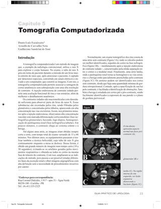 Capítulo 5
         Tomografia Computadorizada
         Dante Luiz Escuissato*
         Arnolfo de Carvalho Neto
         Guilherme Sandrini de Toni


         Introdução                                                              Normalmente, um exame tomográfico dos rins consta de
                                                                           uma série sem contraste (figura 1A), onde os cálculos podem
               A tomografia computadorizada é um método de imagem          ser melhor identificados, seguidos de cortes na fase nefrográ-
         que, a exemplo da radiologia convencional, utiliza o raio X       fica (figura 1B), – imediatamente após a injeção endovenosa
         para explorar o corpo humano. No exame, o tubo de raio X          de contraste iodado –, caracterizados pela nítida separação en-
         gira em torno do paciente durante a emissão de um feixe mui-      tre o córtex e a medular renal. Finalmente, uma série tardia,
         to estreito de raios que, após atravessar o paciente, é captado   onde o parênquima renal torna-se homogêneo e as vias uriná-
         por detectores especiais, convertido em sinais elétricos e en-    rias e a bexiga estão parcialmente preenchidas pelo contraste
         viado a um computador, que constrói as imagens. Com isto, a       (figura 1C). Os ureteres podem ser identificados nos cortes
         tomografia computadorizada permite associar a vantagem de         sem contraste, desde que haja uma quantidade mínima de gor-
         cortes anatômicos sem sobreposição com uma alta resolução         dura retroperitoneal. Contudo, após a opacificação de sua luz
         de contraste. A injeção endovenosa de contraste iodado per-       pelo contraste, é facilitada a identificação de obstruções. Tam-
         mite uma avaliação funcional de rins e vias urinárias, além de    bém a bexiga é estudada em cortes pré e pós-contraste, sendo
         melhorar o detalhamento anatômico.                                facilmente identificados a espessura de sua parede e o plano
               Os contrastes iodados são macromoléculas com densida-       de gordura perivesical.
         de suficiente para absorver parte do feixe de raios X. Essas
         substâncias são excretadas pelos rins, sendo filtradas pelos
         glomérulos e concentradas pelos túbulos, aparecendo em alta        Figura   1
         concentração nas vias excretoras. Assim, nos primeiros minu-
         tos após a injeção endovenosa, observamos alta concentração
         vascular com marcada diferenciação corticomedular (fase ne-
         frográfica glomerular), havendo, logo depois, homogenei-
         zação do parênquima renal (fase nefrográfica tubular). Em
         poucos minutos, o contraste chega ao sistema coletor e à                                                     O rim direito
         bexiga.                                                                                                      apresenta aspecto
               Até alguns anos atrás, as imagens eram obtidas sempre                                                  normal nas fases pré-
         corte a corte, com tempo total de exame variando de 15 a 40                                                  contraste (A),
         minutos. Nos últimos anos, os equipamentos passaram a rea-
         lizar também a técnica helicoidal, cujo tubo de raio X gira
         continuamente enquanto a mesa se desloca. Dessa forma, é
         obtido um grande número de imagens num tempo curto (10 a
         30 segundos), evitando-se os artefatos gerados pelos movi-
         mentos respiratórios e obtendo-se todos os cortes na mesma
         fase de trânsito do contraste. Com isso, ampliaram-se as indi-
         cações do método, pois passou a ser possível estudar diferen-                                                glomerular (B) e
         tes fases da excreção renal e obter imagens angiográficas com
         alta definição sem a necessidade de procedimentos invasivos
         por cateter.
                                                                                                                      tardia (C). Na região
                                                                                                                      interna do rim
                                                                                                                      esquerdo, ver lesão
         *Endereço para correspondência:
                                                                                                                      expansiva
         Rua Coronel Dulcídio, 1.917 - apto 31 - Água Verde                                                           distorcendo o
         80250-100 - Curitiba - PR                                                                                    bacinete (figura 1C).
         Tel.: (0--41) 335-2325

                                                                                         GUIA PRÁTICO DE UROLOGIA                        23


Cap 05 - Tomografia Comp.pm6     23                                                        13/06/00, 13:11
 