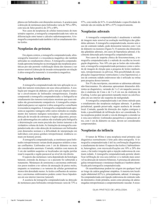 plásica em linfonodos com dimensões normais. A acurácia para       97%, com média de 81%. A sensibilidade e especificidade do
         a detecção de metástases para linfonodos varia de 70% a 90%,       método são em média de 80% e 87% respectivamente.
         com taxa de falso-positivo de 25% a 40%.
               Nos casos de neoplasias de células transicionais do trato    Neoplasias adrenais
         urinário superior, a tomografia computadorizada tem valor na
         diferenciação entre tumor e cálculos radiotransparentes. A to-           A tomografia computadorizada é atualmente o método
         mografia computadorizada também é útil no estadiamento des-        de imagem mais sensível na avaliação morfológica das glân-
         tas lesões.                                                        dulas adrenais. A tomografia computadorizada, mesmo sem o
                                                                            uso de contraste iodado, pode demonstrar tumores com 1 cm
         Neoplasias da próstata                                             de diâmetro ou menores (figura 5). O aumento das dimensões
                                                                            das glândulas adrenais, em casos de hiperplasia adrenal, é fa-
               Em alguns centros, a tomografia computadorizada, ultra-      cilmente detectado pela tomografia computadorizada.
         sonografia transretal e a ressonância magnética são também               Nos casos de suspeita clínica de feocromocitoma, a to-
         utilizadas no estadiamento clínico. A tomografia computado-        mografia computadorizada é o método de escolha na investi-
         rizada apresenta limitações na investigação das neoplasias pros-   gação diagnóstica. Nos 10% em que as lesões são extra-adre-
         táticas por não permitir visibilização direta dos tumores e ser    nais, a tomografia computadorizada permanece como o méto-
         menos sensível à detecção de invasão extracapsular em relação      do de imagem de eleição para a pesquisa de lesões mediasti-
         à ultra-sonografia transretal e à ressonância magnética.           nais, retroperitoneais ou pélvicas. Pela possibilidade de com-
                                                                            plicações (taquiarritmias ventriculares e crise hipertensiva), o
                                                                            uso de contraste iodado endovenoso não é utilizado na rotina
         Neoplasias testiculares                                            para pesquisa desses tumores.
                                                                                  Em 5% das necrópsias, encontram-se adenomas adrenais
              A tomografia computadorizada não tem aplicação no es-
                                                                            não-funcionantes. Os adenomas apresentam dimensões dife-
         tudo dos tumores testiculares em seus sítios primários. A ava-
                                                                            rentes ao diagnóstico, variando de 1 a 2 cm naqueles associa-
         liação por imagem do abdome e pelve tem por objetivo detec-
                                                                            dos à síndrome de Conn e de 3 a 8 cm nos da síndrome de
         tar o envolvimento de linfonodos retroperitoneais. Estudos
                                                                            Cushing. Lesões que apresentem tamanho maior ou calcifica-
         comparando a tomografia computadorizada e a linfografia no
                                                                            ções em seu interior são suspeitas de malignidade.
         estadiamento dos tumores testiculares mostram que esses mé-
                                                                                  A tomografia computadorizada é um ótimo método para
         todos são grosseiramente comparáveis. A tomografia compu-
                                                                            o estadiamento das neoplasias malignas adrenais. A gordura
         tadorizada parece ser superior à ultra-sonografia e semelhante
                                                                            periadrenal, quando preservada, sugere ausência de invasão
         à ressonância magnética. A tomografia computadorizada apre-
                                                                            local. Contudo, quando há distorção dos órgãos contíguos à
         senta as seguintes vantagens sobre outros métodos no estadia-
                                                                            lesão, a possibilidade de infiltração deve ser considerada. Es-
         mento dos tumores malignos testiculares: não-invasividade,
                                                                            tas neoplasias podem invadir a veia de drenagem e estender-se
         detecção de invasão de estruturas e órgãos adjacentes, presen-
                                                                            à veia cava inferior. Linfonodos paraaórticos e paracavais al-
         ça de adenomegalias em cadeias não avaliadas pela linfografia
                                                                            tos, com 1 cm de diâmetro ou mais, devem ser considerados
         e determinação com maior precisão dos limites tumorais e do
                                                                            comprometidos.
         verdadeiro volume da lesão. As limitações da tomografia com-
         putadorizada são a não-detecção de metástases em linfonodos
         com dimensões normais e a dificuldade de interpretação em          Neoplasias da infância
         indivíduos com pouca gordura retroperitoneal, tendência co-
         mum em homens jovens.                                                    O tumor de Wilms é uma neoplasia renal primária cujo
              À tomografia computadorizada, as metástases para linfo-       diagnóstico normalmente é feito pela ultra-sonografia. A to-
         nodos retroperitoneais variam desde pequenos nódulos a mas-        mografia computadorizada é útil na confirmação diagnóstica
         sas confluentes. Linfonodos com 1 cm de diâmetro ou mais           e estadiamento do tumor. O aspecto das lesões é, habitualmen-
         são considerados anormais. Contudo, nódulos com menos de           te, heterogêneo, com microcalcificações em 10% a 20% dos
         1 cm são também suspeitos se localizados em região periilar        casos, e há realce irregular após a injeção endovenosa de con-
         renal à esquerda e região paracaval ao nível do rim direito.       traste iodado. A tomografia computadorizada permite identi-
              O aspecto das metástases varia dependendo da histologia       ficar infiltração de veia cava inferior e é o método mais sensí-
         tumoral, extensão da doença e se o paciente foi submetido a        vel na detecção de tumores bilaterais. A presença de adenome-
         tratamento. Metástases de seminoma e carcinomas embrioná-          galias retroperitoneais e metástases hepáticas é também identi-
         rios puros tendem a ter valores de atenuação de partes moles,      ficada pela tomografia computadorizada.
         enquanto os teratomas e os tumores de células germinativas               Os neuroblastomas podem ter origem em qualquer local
         mistos têm densidade menor. As lesões confluentes de semino-       ao longo da cadeia ganglionar simpática. A maioria tem locali-
         ma e carcinomas embrionários podem conter focos hipoden-           zação abdominal (65%) e, principalmente, adrenal. A tomogra-
         sos em seu interior (necrose tumoral).                             fia computadorizada com injeção endovenosa de contraste ioda-
              A acurácia da tomografia computadorizada na detecção          do demonstra a lesão primária, assim como presença de adeno-
         de metástases para linfonodos retroperitoneais varia de 73% a      megalias retroperitoneais e comprometimento vascular. A resso-

                                                                                        GUIA PRÁTICO DE UROLOGIA                        25


Cap 05 - Tomografia Comp.pm6      25                                                       13/06/00, 13:11
 