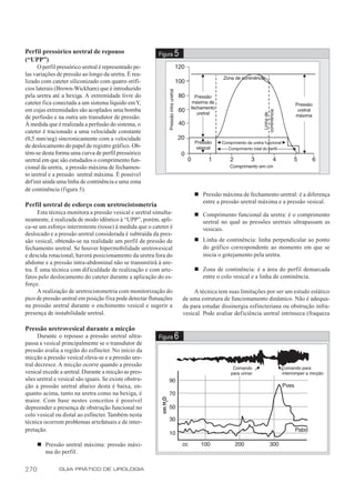 Perfil pressórico uretral de repouso                     Figura    5
(“UPP”)
      O perfil pressórico uretral é representado pe-
las variações de pressão ao longo da uretra. É rea-
lizado com cateter siliconizado com quatro orifí-
cios laterais (Brown-Wickham) que é introduzido
pela uretra até a bexiga. A extremidade livre do
cateter fica conectada a um sistema líquido em Y,
em cujas extremidades são acoplados uma bomba
de perfusão e na outra um transdutor de pressão.
À medida que é realizada a perfusão do sistema, o
cateter é tracionado a uma velocidade constante
(0,5 mm/seg) sincronicamente com a velocidade
de deslocamento do papel de registro gráfico. Ob-
tém-se desta forma uma curva de perfil pressórico
uretral em que são estudados o comprimento fun-
cional da uretra, a pressão máxima de fechamen-
to uretral e a pressão uretral máxima. É possível
definir ainda uma linha de continência e uma zona
de continência (figura 5).
                                                                           n Pressão máxima de fechamento uretral: é a diferença
                                                                             entre a pressão uretral máxima e a pressão vesical.
Perfil uretral de esforço com uretrocistometria
      Esta técnica monitora a pressão vesical e uretral simulta-           n Comprimento funcional da uretra: é o comprimento
neamente, é realizada de modo idêntico à “UPP”, porém, apli-                 uretral no qual as pressões uretrais ultrapassam as
ca-se um esforço intermitente (tosse) à medida que o cateter é               vesicais.
deslocado e a pressão uretral considerada é subtraída da pres-
são vesical, obtendo-se na realidade um perfil de pressão de               n Linha de continência: linha perpendicular ao ponto
fechamento uretral. Se houver hipermobilidade uretrovesical                  do gráfico correspondente ao momento em que se
e descida rotacional, haverá posicionamento da uretra fora do                inicia o gotejamento pela uretra.
abdome e a pressão intra-abdominal não se transmitirá à ure-
tra. É uma técnica com dificuldade de realização e com arte-               n Zona de continência: é a área do perfil demarcada
fatos pelo deslocamento do cateter durante a aplicação do es-                entre o colo vesical e a linha de continência.
forço.
      A realização de uretrocistometria com monitorização do                A técnica tem suas limitações por ser um estudo estático
pico de pressão uretral em posição fixa pode detectar flutuações       de uma estrutura de funcionamento dinâmico. Não é adequa-
na pressão uretral durante o enchimento vesical e sugerir a            da para estudar dissinergia esfincteriana ou obstrução infra-
presença de instabilidade uretral.                                     vesical. Pode avaliar def iciência uretral intrínseca (fraqueza

Pressão uretrovesical durante a micção
      Durante o repouso a pressão uretral ultra-         Figura    6
passa a vesical principalmente se o transdutor de
pressão avalia a região do esfíncter. No início da
micção a pressão vesical eleva-se e a pressão ure-
tral decresce. A micção ocorre quando a pressão
vesical excede a uretral. Durante a micção as pres-
sões uretral e vesical são iguais. Se existe obstru-
ção a pressão uretral abaixo desta é baixa, en-
quanto acima, tanto na uretra como na bexiga, é
maior. Com base nestes conceitos é possível
depreender a presença de obstrução funcional no
colo vesical ou distal ao esfíncter. Também nesta
técnica ocorrem problemas artefatuais e de inter-
pretação.

      n Pressão uretral máxima: pressão máxi-
        ma do perfil.


270            GUIA PRÁTICO DE UROLOGIA
 