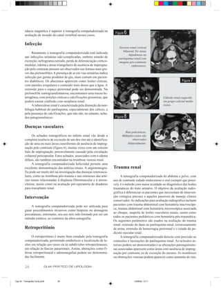 nância magnética é superior à tomografia computadorizada na
         avaliação de invasão do canal vertebral nesses casos.
                                                                             Figura   6

         Infecção
                                                                               Necrose renal cortical
                                                                                  bilateral. Ver áreas
              Raramente a tomografia computadorizada está indicada
                                                                                       hipodensas no
         nas infecções urinárias não-complicadas, embora retardo de            parênquima renal com
         excreção, nefrograma estriado, perda de diferenciação córtico-        imagens pós-contraste
         medular, edema e áreas triangulares de ausência de impregna-                    endovenoso.
         ção pelo contraste possam ser observados nas formas mais gra-
         ves das pielonefrites. A presença de ar em vias urinárias indica
         infecção por germe produtor de gás, mais comum em pacien-
         tes diabéticos. Os abscessos aparecem como lesões císticas,                                                           Figura   7
         com paredes irregulares e conteúdo mais denso que a água. A
         extensão para o espaço perirrenal pode ser demonstrada. Na
         pielonefrite xantogranulomatosa, encontramos uma massa he-
         terogênea, com porções císticas e calcificações grosseiras, que                                         Cálculo renal esquerdo
         podem causar confusão com neoplasia renal.                                                              em grupo calicial médio
              A tuberculose renal é caracterizada pela distorção da mor-                                         (seta).
         fologia habitual do parênquima, especialmente dos cálices, e
         pela presença de calcificações, que não são, no entanto, acha-
         dos patognomônicos.                                                 Figura   8
         Doenças vasculares
                                                                                    Rins policísticos.
               Os achados tomográficos no infarto renal vão desde a               Múltiplos cistos são
         completa ausência de excreção de um dos rins até a identifica-                   observados
         ção de uma ou mais áreas cuneiformes de ausência de impreg-                  bilateralmente.
         nação pelo contraste (figura 6), muitas vezes com um estreito
         halo de impregnação, provavelmente causado pela circulação
         colateral pericapsular. Estes achados, associados com o edema
         difuso, são também encontrados na trombose venosa renal.
               A tomografia computadorizada helicoidal permite uma
         excelente demonstração das artérias renais. A angiotomogra-        Trauma renal
         fia pode ser muito útil na investigação das doenças renovascu-
         lares, como na trombose pós-trauma e nas estenoses das arté-             A tomografia computadorizada do abdome e pelve, com
         rias renais relacionadas à displasia fibromuscular e à ateros-     uso de contraste iodado endovenoso e oral (sempre que possí-
         clerose, assim como na avaliação pré-operatória de doadores        vel), é o método com maior acuidade no diagnóstico das lesões
         para transplante renal.                                            traumáticas do trato urinário. O objetivo da avaliação radio-
                                                                            gráfica é diferenciar os pacientes que necessitam de interven-
         Intervenção                                                        ção cirúrgica precoce e aqueles passíveis de manejo clínico
                                                                            conservador. As indicações para avaliação radiográfica incluem
                                                                            pacientes com trauma abdominal com hematúria macroscópi-
              A tomografia computadorizada pode ser utilizada para
                                                                            ca, trauma abdominal com hematúria microscópica associada
         guiar procedimentos invasivos como biópsias ou drenagens
                                                                            ao choque, suspeita de lesões vasculares renais, assim como
         percutâneas; entretanto, seu uso tem sido limitado por ser um
                                                                            todos os pacientes pediátricos com hematúria pós-traumática.
         método estático, ao contrário da ultra-sonografia.
                                                                            Os seguintes parâmetros são usados na avaliação do trauma
                                                                            renal: extensão do dano ao parênquima renal, extravasamento
         Retroperitônio                                                     de urina, extensão da hemorragia perirrenal e o estado do pe-
                                                                            dículo vascular renal.
              O retroperitônio é muito bem estudado pela tomografia               A tomografia computadorizada detecta com precisão as
         computadorizada, permitindo estabelecer a localização de le-       contusões e lacerações do parênquima renal. As oclusões ar-
         sões em relação aos vasos ou às subdivisões retroperitoneais,      teriais podem ser demonstradas e as alterações parenquimato-
         em relação às fascias pararrenais. Assim, alterações como fi-      sas associadas aparecem como áreas com ausência de impreg-
         brose retroperitoneal e adenomegalias podem ser demonstra-         nação por contraste ou de excreção do mesmo. As tromboses
         das facilmente.                                                    ou obstruções venosas podem aparecer como aumento do rim,

         26                GUIA PRÁTICO DE UROLOGIA



Cap 05 - Tomografia Comp.pm6      26                                                       13/06/00, 13:11
 