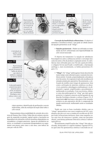 Figura   7                                     Figura   8                              Figura   9
                            Representação                         Na técnica de                                Na técnica de
                            esquemática da                        Marshall-Marchetti-                          Bursh, a fáscia
                            plicatura fascial                     Krantz, a correção                           perivaginal é
                            na correção da                        por via suprapúbica                          fixada ao
                            cistocele e da                        é feita pela                                 ligamento de
                            incontinência                         fixação da fáscia                            Cooper.
                            por via vaginal                       periuretral ao
                            (Kelly-Kennedy).                      periósteo do púbis.




                                                                      Correção da insuficiência esfincteriana - O objetivo é
 Figura   10                                                     aumentar a resistência uretral, o que pode ser obtido através
                                                                 de injeções periuretrais ou de “slings”.

                                                                     • Injeções periuretrais - Podem ser utilizadas no trata-
      A introdução da                                                  mento da IUE esfincteriana sem hipermobilidade do
        agulha é feita                                                 colo vesical associada.
         com controle
         endoscópico.                                                 O objetivo do tratamento é a injeção de substâncias
                                                                 biocompatíveis entre a submucosa uretral e o envelope mus-
                                                                 cular da uretra a fim de produzir coaptação uretral. As subs-
 Figura   11                                                     tâncias mais utilizadas para esse fim são a pasta de teflon,
                                                                 o colágeno bovino purificado e estabilizado, a lipoinjeção
         Representação
        esquemática da                                           autóloga e, mais recentemente, os balões periuretrais (fi-
  injeção periuretral de                                         gura 11).
       balões de silicone
         cujo objetivo é                                             • “Slings”. Os “slings” pubovaginais foram descritos há
    melhorar a coaptação                                               muito tempo como alternativa para o aumento da resis-
     da mucosa uretral.                                                tência uretral. A tensão, propositadamente colocada ao
                                                                       nível da uretra, foi responsável pela alta incidência de
 Figura   12                                                           retenção urinária pós-operatória. Recentemente, a uti-
                                                                       lização de retalhos mais longos de aponeurose, bem
  A alça pubovaginal                                                   como a utilização de materiais sintéticos ou absor-
   proporciona apoio                                                   víveis, permitiu a abordagem combinada por via ab-
      posterior para a                                                 dominal e vaginal, simplificando o procedimento e
   uretra, de maneira                                                  melhorando os resultados. Com essa técnica, obtém-
    que a mobilidade
                                                                       se uma alça pubovaginal ou “sling” que dará apoio
     fisiológica com o
  esforço oclui o colo
                                                                       posterior e coaptará a mucosa uretral quando da sua
               vesical.                                                descida fisiológica durante o esforço (figura 12). É
                                                                       importante não tracionar a alça para evitar retenção
                                                                       urinária no pós-operatório devido à compressão da
                                                                       junção uretrovesical, melhorando assim os resultados
       cópico permite a identificação de perfurações vesicais          obtidos.
       inadvertidas, além da avaliação da tração ideal sobre o
       colo vesical.                                                  Tendo em vista os bons resultados obtidos com os
                                                                 “slings” aponeuróticos nos casos complexos de IUE, acre-
     Representantes dessa modalidade de correção são as téc-     ditamos que deva ser essa a conduta de escolha nos de IUE
nicas de Stamey, Raz e Gittes. Todas têm em comum a ancora-      por lesão esfincteriana intrínseca, bem como naqueles ca-
gem da suspensão na parede vaginal sujeita a lacerações na       sos cujo risco de insucesso é grande, como nas pacientes
dependência de alterações tróficas hormônio-dependentes ou       obesas, com doença pulmonar obstr utiva crônica e radiote-
secundárias a cirurgias anteriores. Apesar de satisfatórios no   rapia pélvica.
início, os resultados se mostraram desapontadores no segui-           Recentemente simplificações dos “slings” têm sido re-
mento com prazos entre cinco e sete anos, com índices de         alizadas, destacando-se o suporte tendíneo vagianal (STV),
cura por volta de 50%.                                           no qual uma fita aponeurótica sintética é ancorada aos ar-

                                                                             GUIA PRÁTICO DE UROLOGIA                    283
 