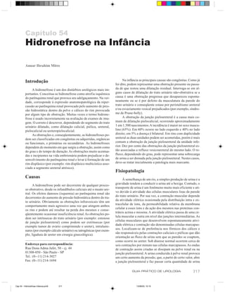 Capítulo 54
          Hidronefrose na Infância

          Anuar Ibrahim Mitre



          Introdução                                                              Na infância as principais causas são congênitas. Como já
                                                                            foi dito, podem representar uma obstrução presente ou passa-
               A hidronefrose é um dos distúrbios urológicos mais im-       da de que restou uma dilatação residual. Interroga-se em al-
          portantes. Conceitua-se hidronefrose como atrofia isquêmica       guns casos de dilatação do trato urinário não-obstrutiva se a
          do parênquima renal que provoca seu adelgaçamento. Na ver-        causa é uma obstrução pregressa que desapareceu esponta-
          dade, corresponde à expressão anatomopatológica da reper-         neamente ou se é por defeito da musculatura da parede do
          cussão ao parênquima renal provocado pelo aumento de pres-        trato urinário e conseqüente estase por peristaltismo ureteral
          são hidrostática dentro da pelve e cálices do rim provocada       e/ou esvaziamento vesical prejudicados (por exemplo, síndro-
          por algum tipo de obstrução. Muitas vezes o termo hidrone-        me de Prune-belly).
          frose é usado incorretamente na avaliação de exames de ima-             A obstrução da junção pieloureteral é a causa mais co-
          gem. O correto é descrever, dependendo do segmento do trato       mum de dilatação pielocalicial, ocorrendo aproximadamente
          urinário dilatado, como dilatação calicial, piélica, ureteral,    1 em 1.500 nascimentos. A incidência é maior no sexo mascu-
          pielocalicial ou ureteropielocalicial.                            lino (65%). Em 60% ocorre no lado esquerdo e 40% no lado
               As obstruções e, conseqüentemente, as hidronefroses po-      direito; em 5% a doença é bilateral. Em rins com duplicidade
          dem ser classificadas em congênitas ou adquiridas, orgânicas      ureteral as duas unidades podem ser acometidas, porém é mais
          ou funcionais, e primárias ou secundárias. As hidronefroses       comum a obstrução da junção pieloureteral da unidade infe-
          dependem do momento em que surgiu a obstrução, assim como         rior. Dez por cento das obstruções da junção pieloureteral es-
          do grau e do tempo de duração. As obstruções muito acentua-       tão associadas a refluxo vesicoureteral do mesmo lado. O re-
          das e incipientes na vida embrionária podem prejudicar o de-      fluxo, dependendo do grau, pode representar uma sobrecarga
          senvolvimento do parênquima renal e levar à formação de um        de urina a ser drenada pela junção pieloureteral. Nestes casos,
          rim displásico (por exemplo: rim displásico multicístico asso-    deve-se tratar inicialmente a patologia mais marcante.
          ciado a segmento ureteral atrésico).
                                                                            Fisiopatologia
          Causas                                                                  À semelhança de um rio, a simples produção de urina e a
                                                                            gravidade tendem a conduzir a urina até a bexiga. Contudo, o
                A hidronefrose pode ser decorrente de qualquer proces-
                                                                            transporte de urina é um fenômeno muito mais eficiente e ati-
          so obstrutivo, desde os infundíbulos caliciais até o meato ure-
                                                                            vo devido à atividade das células musculares lisas da parede
          tral. Os efeitos danosos (isquemia) ao parênquima renal são
                                                                            do trato urinário. Por sua vez, a contração muscular depende
          decorrentes do aumento de pressão hidrostática dentro do tra-
                                                                            da atividade elétrica ocasionada pela distribuição intra e ex-
          to urinário. Obviamente as obstruções infravesicais têm um
                                                                            tracelular de íons, da permeabilidade relativa da membrana
          comportamento mais agressivo uma vez que atingem ambos
                                                                            celular a esses íons e da ação dos mesmos nas proteínas con-
          os rins e podem até resultar na perda dos mesmos e conse-
                                                                            tráteis actina e miosina. A atividade elétrica passa de uma cé-
          qüentemente ocasionar insuficiência renal. As obstruções po-
                                                                            lula muscular a outra em nível das junções intermediárias. As
          dem ser intrínsecas do trato urinário (por exemplo: estenose
                                                                            células musculares que desenvolvem espontaneamente ativi-
          de junção pieloureteral) como podem ser extrínsecas (por
                                                                            dade elétrica e contração são denominadas células marcapas-
          exemplo tumor de ovário comprimindo o ureter), intralumi-
                                                                            sos. Localizam-se de preferência nos fórnices dos cálices e
          nares (por exemplo cálculo urinário) ou iatrogênicas (por exem-
                                                                            são responsáveis pelas contrações caliciais e piélicas que dão
          plo, ligadura de ureter em cirurgia ginecológica).
                                                                            orientação ao fluxo de urina sem que as paredes se coaptem,
                                                                            como ocorre no ureter. Sob diurese normal ocorrem cerca de
          Endereço para correspondência:                                    seis contrações por minuto nas células marcapassos. As ondas
          Rua Dona Adma Jafet, 50 - cj. 44                                  de contração assim criadas se dissipam na pelve renal ou na
          01308-050 - São Paulo - SP                                        junção pieloureteral. A urina conduzida à pelve renal provoca
          Tel.: (0--11) 214-3027                                            um certo aumento da pressão, que, a partir de certo valor, abre
          Fax: (0--11) 214-1694                                             a junção pieloureteral e faz passar certa quantidade de urina

                                                                                        GUIA PRÁTICO DE UROLOGIA                     317


Cap 54 - Hidronefrose Infancia.pm6   317                                                   13/06/00, 15:15
 