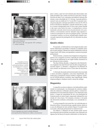 para o ureter, a qual serve de estímulo para desencadear uma
             Figura    1                                                onda peristáltica que conduz um bolo de urina para a bexiga.
                                                                        Ocorrem de duas a seis contrações peristálticas ureterais por
                                                                        minuto a uma velocidade de 2 a 5 cm/seg. A pressão piélica e
                                                                        ureteral varia em média de 0 a 5 cm de H2O. A pressão urete-
                                                                        ral provocada pela contração peristáltica varia de 20 a 60 cm
                                                                        de H2O. Sob diurese abundante, a parede ureteral não se coap-
                                                                        ta, e a urina é transportada como se fosse uma coluna líquida
                                                                        e não mais como bolos de urina. A complacência vesical,
                                                                        mantendo a pressão intravesical em praticamente zero, pos-
                                                                        sibilita o esvaziamento ureteral. Quando surge alguma re-
                                                                        sistência à passagem de urina em qualquer ponto, a pressão
                                                                        a montante começa a se elevar, prejudicando a função e pro-
                                                                        vocando isquemia do parênquima do rim obstruído em graus
              Ultra-sonografia gestacional demonstrando                 variáveis.
              hidronefrose bilateral
              (RD: rim direito; RE: rim esquerdo; EST: estômago e       Quadro clínico
              C: coluna vertebral).
                                                                             No passado, as hidronefroses eram diagnosticadas como
                                                                        massas abdominais percebidas à inspeção ou palpadas pelos
                                                                        pais ou pelo pediatra. Metade das massas abdominais eram de
             Figura    2                                                origem renal e 40% delas correspondiam a estenose da junção
                                                                        pieloureteral.
                                                                             Posteriormente, a maneira mais freqüente de diagnóstico
                                                                        passou a ser a urografia excretora, indicada por manifestação
                                                                        clínica de dor abdominal ou em região lombar, hematúria ou
                        Urografia excretora
                                                                        por infecção do trato urinário.
                   demonstrando dilatação                                    Nas duas últimas décadas, o diagnóstico das hidronefro-
              pielocalicial direta e retardo                            ses congênitas tem sido feito por meio da ultra-sonografia ges-
               na eliminação de contraste.                              tacional (figura 1). Portanto, o diagnóstico de dilatação do
                       Observa-se a bexiga                              trato urinário em diferentes níveis é feito antes do nascimen-
                        contrastada e o rim                             to.
                              esquerdo, que                                  A obstrução da junção pieloureteral pode estar associada
                  já eliminou praticamente                              a outras anomalias congênitas, como ânus imperfurado, rim
                           todo o contraste.
                                                                        multicístico contralateral, doença cardíaca congênita, síndro-
                                                                        me de VATER (defeitos vertebrais, ânus imperfurado, fístula
                                                                        traqueoesofágica e displasia renal) e atresia de esôfago.


             Figura    3                                                Diagnóstico
                                                                             A urografia excretora evidencia o rim hidronefrótico pelo
                                                                        retardo na contrastação e na eliminação de contraste iodado,
                                                                        além de evidenciar a dilatação calicial, piélica e ureteral de-
                                                                        pendendo do nível da obstrução (figura 2). Em obstruções mais
                                                                        graves, o tempo de contrastação do rim e da eliminação do
                                                                        contraste pode ser muito longo, requerendo radiografias com
                                                                        retardo de várias horas. Em situações extremas o rim pode
                                                                        não demonstrar nenhuma contrastação e ser considerado ex-
                                                                        cluso.
                                                                             A uretrocistografia miccional deve ser realizada para se
                                                                        descartar refluxo vesicoureteral que, quando maciço, pode ser
                                                                        a causa da dilatação do trato urinário (figura 3) ou pode estar
                                                                        associado a obstrução pieloureteral ou ureterovesical.
           Uretrocistografia miccional revelando dilatação
                                                                             Na infância, a dilatação do trato urinário pode ocorrer
           ureteropielocalicial bilateral por refluxo vesicoureteral.   sem obstrução (provavelmente associada a uma obstrução em
                                                                        alguma fase do desenvolvimento embrionário ou fetal que de-


          318                 GUIA PRÁTICO DE UROLOGIA



Cap 54 - Hidronefrose Infancia.pm6    318                                              13/06/00, 15:15
 