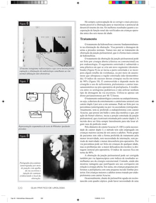 Há sempre a preocupação de se corrigir o mais precoce-
             Figura    6                                                  mente possível a obstrução para se maximizar o potencial de
                                                                          desenvolvimento do rim. Os melhores resultados quanto a re-
                                                                          cuperação de função renal são verificados em crianças opera-
                                                                          das antes dos seis meses de idade.

                                                                          Tratamento
                                                                               O tratamento da hidronefrose consiste fundamentalmen-
                                                                          te na eliminação da obstrução. Visa permitir a drenagem de
                                                                          urina a pressões normais. Vamos nos ater ao tratamento da
                                                                          obstrução da junção pieloureteral, que é a forma mais comum
                                                                          de hidronefrose.
                                                                               O tratamento da obstrução da junção pieloureteral pode
                                                                          ser feito por cirurgia aberta (clássica ou convencional) ou
                                                                          por endourologia. O seguimento estreitado é submetido a
                                                                          uma plástica em que se cria um novo segmento (desmem-
              O mesmo renograma radioisotópico cuja curva mostra pronta
             captação e eliminação do radioisótopo semelhante ao rim      brada) (figura 9) ou se incisa a parte estreitada e se incor-
             normal (dilatação não-obstrutiva).                           pora algum retalho da vizinhança, ou por meio de anasto-
                                                                          mose que ultrapassa a região estreitada (não-desmembra-
                                                                          da). O índice de sucesso dessas cirurgias oscila em torno
             Figura     7                                                 de 90% (figura 10). É controvertido e depende muito do
                                                                          cirurgião o uso de nefrostomia, pielostomia e cateter tran-
                                                                          sanastomótico no pós-operatório de pieloplastia. A tendên-
                                                                          cia entre os urologistas pediátricos é não utilizar nenhum
                                                                          tipo de drenagem da via excretora. Utiliza-se apenas um
                                                                          dreno perianastomose por 48-72 horas.
                                                                               O tratamento endourológico consiste na endopielotomia,
                                                                          ou seja, a abertura do estreitamento e cateterismo ureteral com
                                                                          cateter duplo J por seis a oito semanas. Pode ser feito por via
                                                                          percutânea (anterógrada) ou por via ascendente (retrógrada).
                                                                          Atualmente, tem-se preferido a endopielotomia com cateter
                                                                          Acucise, que possui um balão e uma alça metálica e que, por
                                                                          ação do bisturi elétrico, incisa a porção estreitada da junção
                                                                          pieloureteral, que cicatrizará orientada pelo cateter duplo J. A
                                                                          incisão deve ser feita sempre lateralmente para não lesar al-
                                                                          gum vaso do pedículo renal.
           Representação esquemática do teste de Whitaker (perfusão            Pelo diâmetro do cateter Acucise (5-10Fr) e pela necessi-
           pressão).                                                      dade de cateter duplo J, o método tem sido empregado em
                                                                          crianças maiores (acima de seis anos) e adultos. Neste grupo
             Figura    8                                                  de pacientes tem sido a forma preferida de tratamento pela
                                                                          menor invasividade, sem necessidade de internação, sem pe-
                                                                          ríodo de inatividade e menor desconforto pós-operatório. Por
                                                                          via percutânea pode ser feita em crianças de qualquer idade,
                                                                          mas os problemas são: a maior delicadeza dos tecidos e a dre-
                                                                          nagem ureteral pós-operatória. O índice de sucesso fica em
                                                                          torno de 80%.
                                                                               A obstrução da junção pieloureteral pode ser corrigida
                                                                          também por via laparoscópica com índices de resultados se-
                                                                          melhantes aos da cirurgia convencional. Contudo, ainda não
             Pielografia descendente                                      mostrou vantagens que justifiquem seu uso corriqueiro em
             (anterógrada) por meio
                                                                          relação à cirurgia aberta. Em suma, em crianças pequenas pre-
              de punção com agulha
                   da via excretora e                                     ferimos a pieloplastia com uma pequena incisão lombar pos-
                 injeção de contraste                                     terior. Em crianças maiores e adultos temos tratado por endo-
             evidenciando o local da                                      pielotomia com cateter Acucise.
                          obstrução.                                           Ocasionalmente, diante de pielonefrite aguda em recém-
                                                                          nascido com quadro séptico, pode haver necessidade de uma

          320                 GUIA PRÁTICO DE UROLOGIA



Cap 54 - Hidronefrose Infancia.pm6   320                                                 13/06/00, 15:15
 