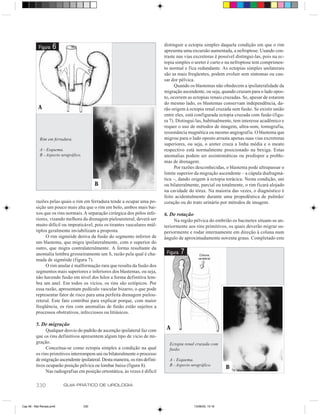 distinguir a ectopia simples daquela condição em que o rim
           Figura    6                                                        apresenta uma excursão aumentada, a nefroptose. Usando con-
                                                                              traste nas vias excretoras é possível distingui-las, pois na ec-
                                                                              topia simples o ureter é curto e na nefroptose tem comprimen-
                                                                              to normal e fica redundante. As ectopias simples unilaterais
                                                                              são as mais freqüentes, podem evoluir sem sintomas ou cau-
                                                                              sar dor pélvica.
                                                                                    Quando os blastemas não obedecem a ipsilateralidade da
                                                                              migração ascendente, ou seja, quando cruzam para o lado opos-
                                                                              to, ocorrem as ectopias renais cruzadas. Se, apesar de estarem
                                                                              do mesmo lado, os blastemas conservam independência, da-
           A                                                                  rão origem à ectopia renal cruzada sem fusão. Se existir união
                                                                              entre eles, está configurada ectopia cruzada com fusão (figu-
                                                                              ra 7). Distingui-las, habitualmente, tem interesse acadêmico e
                                                                              requer o uso de métodos de imagem, ultra-som, tomografia,
                                                                              ressonância magnética ou mesmo angiografia. O blastema que
            Rim em ferradura.                                                 migrou para o lado oposto arrasta apenas suas vias excretoras
                                                                              superiores, ou seja, o ureter cruza a linha média e o meato
            A - Esquema.                                                      respectivo está normalmente posicionado na bexiga. Estas
            B - Aspecto urográfico.                                           anomalias podem ser assintomáticas ou predispor a proble-
                                                                              mas de drenagem.
                                                                                    Por razões desconhecidas, o blastema pode ultrapassar o
                                                                              limite superior da migração ascendente – a cúpula diafragmá-
                                                                              tica –, dando origem à ectopia torácica. Nesta condição, uni
                                            B                                 ou bilateralmente, parcial ou totalmente, o rim ficará alojado
                                                                              na cavidade do tórax. Na maioria das vezes, o diagnóstico é
                                                                              feito acidentalmente durante uma propedêutica de pulmão/
         razões pelas quais o rim em ferradura tende a ocupar uma po-         coração ou do trato urinário por métodos de imagem.
         sição um pouco mais alta que o rim em bolo, ambos mais bai-
         xos que os rins normais. A separação cirúrgica dos pólos infe-       6. De rotação
         riores, visando melhora da drenagem pieloureteral, deverá ser             Na região pélvica do embrião os bacinetes situam-se an-
         muito difícil ou impraticável, pois os tirantes vasculares múl-      teriormente aos rins primitivos, os quais deverão migrar su-
         tiplos geralmente inviabilizam a proposta.                           periormente e rodar internamente em direção à coluna num
              O rim sigmóide deriva da fusão do segmento inferior de          ângulo de aproximadamente noventa graus. Completado este
         um blastema, que migra ipsilateralmente, com o superior do
         outro, que migra contralateralmente. A forma resultante da
         anomalia lembra grosseiramente um S, razão pela qual é cha-           Figura   7
         mada de sigmóide (figura 7).
              O rim anular é malformação rara que resulta da fusão dos
         segmentos mais superiores e inferiores dos blastemas, ou seja,
         não havendo fusão em nível dos hilos a forma definitiva lem-
         bra um anel. Em todos os vícios, os rins são ectópicos. Por
         essa razão, apresentam pedículo vascular bizarro, o que pode
         representar fator de risco para uma perfeita drenagem pielou-
         reteral. Este fato contribui para explicar porque, com maior
         freqüência, os rins com anomalias de fusão estão sujeitos a
         processos obstrutivos, infecciosos ou litiásicos.

         5. De migração
               Qualquer desvio do padrão de ascenção ipsilateral faz com       A
         que os rins definitivos apresentem algum tipo de vício de mi-
         gração.                                                                Ectopia renal cruzada com
               Conceitua-se como ectopia simples a condição na qual             fusão.
         os rins primitivos interrompem uni ou bilateralmente o processo
         de migração ascendente ipsilateral. Desta maneira, os rins defini-     A - Esquema.
         tivos ocuparão posição pélvica ou lombar baixa (figura 8).             B - Aspecto urográfico.
                                                                                                                B
               Nas radiografias em posição ortostática, às vezes é difícil

         330              GUIA PRÁTICO DE UROLOGIA



Cap 56 - Mal Renais.pm6               330                                                     13/06/00, 15:16
 