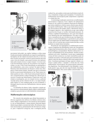 conhecê-las, pois podem evoluir para insuficiência renal crô-
           Figura    8                                                    nica e tratamento cirúrgico pelo transplante. O somatório de
                                                                          malformações microscópicas pode comprometer a superfície
                                                                          e o volume dos rins.
                                                                               A terminologia usada para caracterizar as malformações
                                                                          microscópicas é inprecisa. Com o objetivo de uniformizá-la
                                                                          formou-se um comitê da Academia Americana de Pediatria,
                                                                          que tentou estabelecer critérios menos elásticos para identifi-
                                                                          car aquelas malformações. Sabe-se que muitas dessas anoma-
                                                                          lias microscópicas têm quadro clínico, laboratorial clínico e
                                                                          de imagem sugestivo, mas estabeleceu-se que, para melhor
                                                                          caracterizá-las, há que se recolher informações pessoais, fa-
           A                                                              miliares e também histopatológicas, sem o que seria imprati-
                                                                          cável identificá-las mais adequadamente. Fica aqui a experi-
                                                                          ência e a prudência dos que reconhecem que com alguma fre-
                                                                          qüência o exame histopatológico é questionável, pois sempre
                                                                          envolve algum grau de subjetividade na interpretação. Do que
            Ectopia renal pélvica à
                                                                          foi dito, deve-se concluir que existem muitas dúvidas a serem
            direita.
                                                                          desfeitas no estudo destas anomalias.
            A - Esquema.                                                       Do ponto de vista organogênico as malformações micros-
            B - Aspecto urográfico.                                       cópicas congênitas dos parênquimas renais são conseqüentes
                                            B                             a algum tipo de desarmonia entre o broto ureteral e o blastema
                                                                          metanefrogênico correspondente. Binômio indissociável, vis-
                                                                          to que a normalidade de um, provavelmente, interfere recipro-
         movimento helicoidal, nas regiões lombares os hilos renais
                                                                          camente na do outro. Atualmente, é aceito que a implantação
         ficarão posicionados medialmente aos respectivos parênquimas.
                                                                          viciosa do broto ureteral no seu ducto mesonéfrico pode ser
         Na hipótese de não rodarem da maneira descrita, os rins seus
                                                                          condição necessária e suficiente para gerar anomalias micros-
         hilos ficarão em posições variáveis genericamente descritas
                                                                          cópicas, tanto dos ductos coletores intra-renais quanto dos né-
         como vícios de rotação, cujos graus extremos são represen-
                                                                          frons. Constituem patologias de largo espectro, afetam a es-
         tados pela rotação reversa e a super-rotação. A reversa resul-
                                                                          trutura e podem afetar o tamanho e a forma dos rins. Estas
         ta da movimentação externa do rim primitivo em relação à
                                                                          malformações microscópicas são genericamente denomina-
         coluna, ou seja, o hilo ficará lateralmente ao parênquima e
                                                                          das disgenesias. Esta denominação é tão difundida e consa-
         não medialmente, como seria o normal. Na super-rotação o
                                                                          grada quanto vaga, pois não tem especificidade etimológica
         blastema roda internamente em direção à coluna mas ultra-
                                                                          nem histopatológica. Para serem melhor caracterizadas e en-
         passa o limite desta rotação, fazendo com que as estruturas
         do hilo se posicionem lateralmente ao rim. Tanto numa con-
         dição quanto na outra, o hilo ficará numa posição lateral ao
                                                                           Figura   9
         rim e urograficamente é difícil distingui-las. Haverá que se
         recorrer a exames que identifiquem o trajeto dos vasos com
         relação ao parênquima, pois na rotação reversa o pedículo
         vascular passa na face anterior do rim e, na super-rotação,
         atrás (figura 9). Esta condição pode ser uni ou bilateral, e
         distinguir uma da outra tem, habitualmente, interesse apenas
         acadêmico.                                                        A
              As anomalias de número, fusão, migração e rotação po-
         dem associar-se aleatoriamente dando origem a malformações
         complexas que precisam ser individualmente interpretadas.

         Malformações microscópicas
                                                                             Vícios de rotação.
              Por conceito são anomalias que afetam basicamente os
         diversos segmentos dos néfrons e/ou túbulos coletores intra-        A - Esquema.
         renais. Podem comprometer os rins setorial ou universalmen-         B - Aspecto urográfico.
         te, uni ou bilateralmente e causar prejuízo funcional depen-
         dendo da gravidade e extensão das lesões. Por afetarem estru-
         turas microscópicas, primariamente não têm interesse cirúrgi-
         co, pois é impossível corrigi-las, mas o urologista precisa                                        B

                                                                                        GUIA PRÁTICO DE UROLOGIA                   331


Cap 56 - Mal Renais.pm6               331                                                 13/06/00, 15:16
 