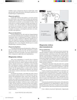 tendidas a rigor, as disgenesias devem ser adjetivadas, ainda
         que para tanto sejam necessárias informações genéticas e/ou
                                                                            Figura   10
         histopatológicas complementares.

         Disgenesia aplástica
              Conhecida também como aplasia, é um tipo extremo
         de malformação, cujo diagnóstico é produto da exploração
         cirúrgica, pois se baseia no exame histopatológico de um
         tecido amorfo localizado na extremidade do ureter. Neste
                                                                            A
         tecido não se reconhece qualquer estrutura que lembre tra-
         to urinário, isto é, não há qualquer evidência de parênqui-
         ma nem de vias excretoras intra-renais. Se forem encontra-
         dos segmentos de néfrons ou ductos coletores ainda que
         vestigiais ou imaturos, esta disgenesia não deve ser carac-
         terizada como aplástica.
                                                                              Cisto renal simples.
         Disgenesia hipoplástica
                                                                              A - Esquema.
              O termo hipoplasia tem sido usado por imagenologistas           B - Aspecto operatório.
         de forma indiscriminada diante de qualquer rim pequeno, não
         importando saber se a diminuição do volume é primária ou
         secundaria, ou seja, congênita ou adquirida. Segundo esse co-
         mitê, esta disgenesia só pode ser diagnosticada mediante o                                          B
         achado de uma menor densidade de glomérulos normais no
         parênquima, isto é, esse colegiado considera que só o exame
         histopatológico caracteriza a doença.
                                                                           Disgenesias císticas
         Disgenesia displástica                                            não-transmissíveis
              É reconhecida pela presença de glomérulos e túbulos ima-
         turos coexistindo com ilhas de tecido cartilaginoso, localiza-    Doença multicística
         das nas camadas corticais dos rins. Se as características              Pelo fato de multicístico e policístico terem o mesmo sig-
         displásticas estiverem associadas a um menor número de né-        nificado semântico, embora com etimologias diferentes, du-
         frons, a disgenesia é adjetivada como hipodisplásica.             rante muito tempo e ainda hoje os termos são usados indistin-
                                                                           tamente. Convencionou-se atualmente que o rim multicístico
         Disgenesias císticas                                              não tem caráter hereditário e o policístico tem, sendo aquele a
                                                                           forma mais freqüente de disgenesia cística da infância (figura
              Sob a ótica organogênica a conexão entre os túbulos          11). O volume dos cistos é muito variável e a histopatologia
         contornados distais dos néfrons com os ductos coletores           poderá identificar glomérulos e túbulos com aspecto pratica-
         intra-renais de terceira ordem é habitual, porém não obri-        mente normal ou imaturos.
         gatória. Quando inexiste ou é imperfeita, a urina formada              O diagnóstico pré-natal é feito pelo ultra-som e quando
         não é devidamente coletada e transportada, dando origem           bilateral a doença multicística habitualmente se acompanha
         aos cistos simples ou às disgenesias císticas respectivamente     de oligoâmnio severo. A insuficiência pulmonar e renal são
         (figura 10). Em algumas delas, o caráter cístico é descrito       condições que freqüentemente leva ao óbito no período neo-
         como sendo devido à dilatação de segmentos dos néfrons            natal.
         ou dos ductos coletores intra-renais e não à retenção fecha-           O ultra-sonografista tem dificuldade em distinguir um
         da da urina.                                                      rim multicístico de um hidronefrótico, o que é da maior im-
              Em função da extensão e gravidade das lesões císticas        portância para o urologista, pois o tratamento é diferente. A
         microscópicas, podem alterar-se as características macros-        presença de uma lesão cística medial maior, outras periféri-
         cópicas dos parênquimas renais, assim como a função dos           cas menores, comunicações entre elas e parênquima reco-
         mesmos. As disgenesias císticas já foram classificadas de         nhecível sugere mais hidronefrose, embora muito raramente
         acordo com a época do seu aparecimento, mas pelo fato da          alguns cistos dos rins multicísticos possam ter comunicação
         policística do tipo infantil poder manifestar-se no adulto, e a   entre si.
         do tipo adulto na infância, verificou-se que o critério etário         A presença de glomérulos funcionantes, detectada pelos
         é falho. Tal fato justificou a procura de outro mais próprio,     exames radiográficos e/ou radioisotópicos, sugere rim mais
         aquele da transmissão genética. Com base neste, atualmente        hidronefrótico que multicístico. Os ureteres dos rins multicís-
         as disgenesias císticas são classificadas em não-transmissíveis   ticos freqüentemente apresentam problemas de permeabilida-
         e transmissíveis, com maior interesse urológico e nefrológico     de.
         respectivamente.                                                       Com o objetivo de prevenir hipertensão e degeneração


         332              GUIA PRÁTICO DE UROLOGIA



Cap 56 - Mal Renais.pm6          332                                                       13/06/00, 15:16
 