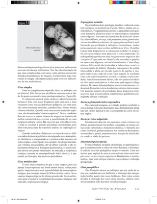 Figura    11                                                     Espongiose medular
                                                                                 Os portadores desta patologia, também conhecida como
                                                                            rim esponjoso ou moléstia de Cacchi e Ricci, podem ser as-
                                                                            sintomáticos. Freqüentemente, porém, se apresentam com quei-
                                                                            xa de hematúria silenciosa micro ou macroscópica, raramente
                                                                            com coágulos. O exame das hemácias da urina não identi-
                                                                            fica dismorfismo, ou seja, não passaram pelos glomérulos,
                                                                            vieram dos túbulos coletores. A espongiose medular é mal-
                                                                            formação que predispõe à infecção e microlitíase, razões
                     Rim multicístico                                       pelas quais não é rara a cólica nefrética ou febre. O melhor
                            infantil.                                       exame para diagnosticar a espongiose medular é a urogra-
                                                                            fia nos seus tempos mais precoces e sem compressão. As
                                                                            radiografias reproduzem uma imagem muito sugestiva dita
                                                                            “em pincel” que pode ser identificada em todas as papilas
                                                                            ou apenas em algumas, uni ou bilateralmente. Como diag-
                                                                            nóstico diferencial são lembradas a tuberculose renal e a
         desses parênquimas disgenéticos já se praticou a nefrectomia       necrose papilar do diabete. Quando a espongiose é de grande
         em casos de doença multicística. Em face da observação de          intensidade e afeta um elevado número de papilas a ima-
         que estas complicações eram raras, e pelo aprimoramento dos        gem lembra um cacho de uvas. Este aspecto se confunde
         métodos propedêuticos de imagem, a nefrectomia hoje é op-          com a da nephronophthisis juvenil e a doença cística me-
         cional. A cirurgia videolaparoscópica pode reviver a nefrecto-     dular, mas diferentemente destas, não tem caráter hereditá-
         mia de rins multicísticos.                                         rio. Nos casos mais típicos, o ultra-som pode sugerir o diag-
                                                                            nóstico. O exame histopatológico caracteristicamente evi-
         Cisto simples                                                      denciará dilatação cística dos ductos coletores intra-renais.
              Pode ser congênito ou adquirido, único ou múltiplo, uni       Um pequeno número de portadores dessa disgenesia císti-
         ou bilateral. Pelo fato de sua incidência aumentar com a ida-      ca evolui para a insuficiência renal crônica, geralmente con-
         de, há quem os considere uma patologia adquirida (figura10).       seqüente a litíase e infecção.
              O volume dos cistos é muito variável, a identificação dos
         mesmos é feita com maior freqüência pelo ultra-som, e mais         Doença glomerulocística esporádica
         raramente como massas abdominais palpáveis. Ao ultra-som,               Os exames de imagem e a evolução poderão confundi-la
         são como estruturas anecóides, paredes finas, limites nítidos      com a doença policística dominante, mas, diferentemente desta,
         e forma esferóide. Quando estas características não são explí-     não tem caráter familiar e não se acompanha de cistos em ou-
         citas, são denominados “cistos complexos”. Nestas condições        tros órgãos.
         deve-se recorrer a outros exames de imagem na tentativa de
         melhor caracterizá-los e excluir a possibilidade de ser uma        Doença cística adquirida
         neoplasia maligna cística. Há casos em que a dúvida persiste,           Inicialmente descrita em pacientes renais crônicos em
         e pode-se recorrer à punção percutânea monitorizada pelo           diálise, posteriormente foi também constatada em renais crô-
         ultra-som para coleta de material e análise, ou exploração ci-     nicos não submetidos a tratamento dialítico. O tamanho dos
         rúrgica.                                                           cistos é variável, podem despertar dor lombar ou hematúria e
              Quando múltiplos e bilaterais, os cistos devem ser dife-      sua incidência parece aumentar com a duração da insuficiên-
         renciados da doença policística investigando-se os anteceden-      cia renal e a idade do paciente.
         tes familiares e pesquisando-se a presença dos mesmos em
         outros órgãos, como fígado, por exemplo. Desde que não atin-       Divertículo pielocalicial
         jam volumes preocupantes, dor de difícil controle e não re-             É uma estrutura cavitária identificada no parênquima e
         presentem obstáculo à drenagem pieloureteral, os cistos sim-       que se comunica com o cálice ou com o bacinete, o divertícu-
         ples devem ser apenas observados. Se indicada, a terapêutica       lo calicial ou cisto pielogênico respectivamente. Uma das
         cirúrgica consiste na marsupialização do(s) cisto(s), o que        teorias para explicá-lo seria a rotura de um cisto renal sim-
         poderá ser feito pela via aberta ou percutânea.                    ples nas vias excretoras superiores. Geralmente é assinto-
                                                                            mático, mas pode abrigar cálculos ou predispor a infecção
         Cisto multilocular                                                 de repetição.
              É lesão mais complexa do que o cisto simples, pois sua
         parede é mais espessa e seu limite menos nítido, razões pelas      Cisto parapiélico
         quais é imperioso descartar a possibilidade de uma neoplasia            São dilatações únicas ou múltiplas que em razão de te-
         maligna; por exemplo, tumor de Wilms do tipo cístico. Se os        rem seu conteúdo rico em linfócitos, a histologia das suas pa-
         exames imagenológicos de última geração não forem sufici-          redes lembra aquela dos vasos linfáticos. Tais cistos seriam
         entes para se excluir a possibilidade de neoplasia maligna, está   devidos à obstrução dos vasos deste sistema, embora cistos
         indicada a exploração cirúrgica.                                   serosos tenham sido descritos nesta localização.

                                                                                        GUIA PRÁTICO DE UROLOGIA                    333


Cap 56 - Mal Renais.pm6                 333                                                13/06/00, 15:16
 