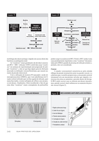 Quadro   1                                                      Quadro     2




morfologia dos ductos protege e impede este acesso direto das   podem surgir na ausência do RVU. Porém o RVU ainda é uma
bactérias ao parênquima renal.                                  causa predisponente importante a estas “cicatrizes” documen-
     As “cicatrizes” renais geralmente são devidas à associa-   tadas pelo DMSA quando da presença de infecção urinária e,
ção RVU + RIR + infecção. O RVU estéril não causa “cicatri-     portanto, deve ser considerado.
zes” em animais de experimentação nem progressão de anti-
gas “cicatrizes”, a não ser que haja algum grau de obstrução    Causas
associado ou disfunção vesicoesfincteriana, que causem au-           A junção vesicoureteral caracteriza-se pela entrada
mento da pressão intravesical.                                  oblíqua da porção terminal do ureter na parede vesical, e a
     Com a utilização do tecnécio-99 marcando o ácido di-       cobertura que o urotélio proporciona a esta porção ureteral
mercaptossuccínico (DMSA), que é um radiofármaco de fi-         intramural cria um mecanismo valvular que impede o re-
xação cortical utilizado quer na fase aguda da infecção, quer   trocesso da urina ao aumentar a pressão dentro da bexiga.
numa fase tardia, o termo nefropatia de refluxo caiu um pou-    O RVU pode ocorrer caso se alterem um desses mecanis-
co em desuso. Atualmente, é bem reconhecido o fato de que       mos, parede vesical, túnel submucoso ou aumento da pres-
estas ditas “cicatrizes” renais conseqüentes da pielonefrite    são vesical (figura 2).




 Figura   1               PAPILAS RENAIS                         Figura   2       MECANISMO ANTI-REFLUXO NORMAL




                                                                 1-Trajeto submucoso longo
                                                                 2- Ureter fixo ao trígono
                                                                 3- Anel de Waldeyer
                                                                 4- Parede vesical posterior
                                                                 5- Contração do trígono
              Simples                  Composta                  6- Oclusão do ureter terminal
                                                                 7- Peristaltismo ureteral



340             GUIA PRÁTICO DE UROLOGIA
 