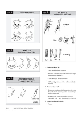 Figura   4          TÉCNICA DE COHEN                    Figura   7                 TÉCNICAS DE
                                                                               AFILAMENTO URETERAL




                                                                                                Hendren




                                                                              Starr




 Figura   5             TÉCNICA DE
                   POLITANO-LEADBETTER
                                                                                                Kalicinsky




                                                            1. Técnica intravesical -

                                                                  • Cohen (avanço lateral) (figura 4);

                                                                  • Politano-Leadbetter (entrada do ureter na bexiga por
                                                                    um novo hiato) (figura 5);

 Figura   6         DETRUSSORORRAFIA                              • Glenn-Anderson (avanço trigonal);
                   (VARIANTE DA TÉCNICA
                     DE LICH-GREGOIR)                             • Gil-Vernet (aproxima os óstios na linha média do
                                                                    trígono).

                                                            2. Técnica extravesical -

                                                                  • detrussororrafia (nos reimplantes bilaterais, evitar
                                                                    dissecções muito laterais, para não causar retenção
                                                                    urinária) (figura 6);

                                                                  • Lich-Gregoir (semelhante a detrussororrafia,
                                     Fixação do ureter              porém sem fixar a parte distal do ureter à bexiga).
                                    terminal na parede
                                        vesical por         3. Técnica intra e extravesical -
                                       ancoramento
                                                                  • Paquin.


344           GUIA PRÁTICO DE UROLOGIA
 