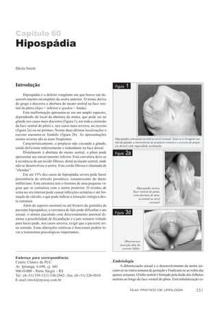 Capítulo 60
Hipospádia

Décio Streit



Introdução                                                           Figura   1
      Hipospádia é o defeito congênito em que houve um de-
senvolvimento incompleto da uretra anterior. O termo deriva
do grego e descreve a abertura do meato uretral na face ven-
tral do pênis (hipo = inferior e spadon = fenda).
      Esta malformação apresenta-se em um amplo espectro,
dependendo do local da abertura da uretra, que pode ser na
glande nos casos mais discretos (figura 1), em toda a extensão
da face ventral do pênis e, nos casos mais severos, no escroto
(figura 2a) ou no períneo. Nestas duas últimas localizações o
escroto encontra-se fendido (figura 2b). As apresentações
menos severas são as mais freqüentes.                               Hipospádia com meato uretral ao nível coronal. Note-se a clivagem ven-
      Caracteristicamente, o prepúcio não circunda a glande,        tral da glande, a inexistência de prepúcio ventral e o excesso de prepú-
                                                                    cio dorsal com rugosidade acentuada.
sendo deficiente inferiormente e redundante na face dorsal.
      Distalmente à abertura do meato uretral, o pênis pode         Figura    2a
apresentar um encurvamento inferior. Esta curvatura deve-se
à existência de um tecido fibroso, distal ao meato uretral, onde
não se desenvolveu a uretra. Esta corda fibrosa é chamada de
“chordee”.
      Em até 15% dos casos de hipospádia severa pode haver
persistência do utrículo prostático, remanescente do ducto
mülleriano. Esta estrutura tem o formato de uma pequena va-
gina que se comunica com a uretra posterior. O resíduo de                            Hipospádia severa.
urina no seu interior pode causar infecções urinárias e até for-                   Face ventral do pênis,
                                                                                   com abertura do mea-
mação de cálculo, o que pode indicar a remoção cirúrgica des-
                                                                                       to uretral ao nível
ta estrutura.                                                                                    escrotal.
      Além do aspecto anormal ou até bizarro da genitália do
paciente hipospádico, a curvatura do falo pode dificultar o ato
sexual, o sêmen ejaculado com direcionamento anormal di-            Figura    3d
minui a possibilidade de fecundação e o jato urinário voltado
para baixo pode, nos casos severos, exigir que o paciente uri-
ne sentado. Estas alterações estéticas e funcionais podem le-
var a transtornos psicológicos importantes.

                                                                            Observa-se a
                                                                        inserção alta do
                                                                          escroto bífido.


Endereço para correspondência:
Centro Clínico da PUC                                              Embriologia
Av. Ipiranga, 6.690, cj. 601                                            A diferenciação sexual e o desenvolvimento da uretra ini-
90610-000 - Porto Alegre - RS                                      ciam-se na oitava semana de gestação e finalizam-se ao redor das
Tel.: (0--51) 339-1211/336-2942 - Fax: (0--51) 320-5010            quinze semanas. O tubo uretral é formado pela fusão dos folhetos
E-mail:streit@myway.com.br                                         uretrais ao longo da face ventral do pênis. Esta tubularização es-

                                                                                  GUIA PRÁTICO DE UROLOGIA                              351
 