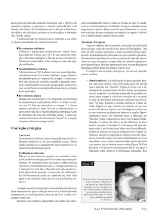 ções, pode ser utilizado estímulo hormonal com o objetivo de     ções marcadamente maior e todas as formas de profilaxia de-
aumentar o pênis, a espessura e vascularização da pele e do      vem ser meticulosamente utilizadas: lavagem cuidadosa com
tecido subcutâneo. O metabolismo acelerado deve diminuir a       degermante algumas horas antes do procedimento e a tricoto-
incidência de infecções, acelerar a cicatrização e a absorção    mia realizada na mesa cirúrgica ao repetir a lavagem. Antibió-
dos fios de sutura.                                              tico é administrado algumas horas antes.
     A administração de testosterona ou estímulo a sua sínte-
se são recomendadas nas seguintes formas:                        Técnicas cirúrgicas
                                                                      Foge ao objetivo deste capítulo a descrição detalhada de
     n Testosterona sistêmica                                    técnicas para correção dos diversos graus de hipospádia. Das
       Utiliza-se 2 mg/kg/dose de testosterona “depot” intra-    mais de 300 técnicas descritas, o autor escolheu mostrar ape-
       muscular em 2 doses, aos 40 e 20 dias antes da cirur-     nas três freqüentemente utilizadas em seu repertório pessoal.
       gia. Tem como vantagem o fato de as doses serem per-      Elas demonstram alternativas de reconstrução mas não preen-
       feitamente controladas. A desvantagem é que são inje-     chem os requisitos para corrigir todas as variadas apresenta-
       ções doloridas.                                           ções da patologia. O leitor interessado deve buscar descrições
     n Gonadotrofina coriônica                                   detalhadas de técnicas em artigos específicos.
       Administram-se 50 Unidades Internacionais/kg/dose,             O objetivo da correção cirúrgica é, em um só procedi-
       num intervalo de 3 em 3 dias, 10 doses, programando o     mento, realizar:
       seu término para as vésperas da cirurgia. O autor pre-
       fere esta forma de estímulo quando o paciente apre-            • Ortofaloplastia: é a retificação do pênis quando pos-
       senta criptorquidia associada, porque pode promover a            sui curvatura ventral. Esta retificação pode ser obtida
       cura ou melhorar as condições técnicas para a correção           com a retirada do “chordee” (figura 6) e/ou com a di-
       desta patologia.                                                 minuição do comprimento da face dorsal ou aumento
                                                                        ventral do pênis. A avaliação adequada do grau de cur-
     n Testosterona tópica                                              vatura nem sempre é viável no consultório e em geral
       Pomada de testosterona a 5% preparada em farmácia                os pais não fornecem informação suficiente neste sen-
       de manipulação é aplicada no pênis 1 vez/dia, ao dei-            tido. Por isso, durante a cirurgia utiliza-se o teste de
       tar, nos 25 dias que precedem a cirurgia. É a forma              Gittes (figura 4), que consiste em colocar um garrote
       menos traumática e mais fácil de ser administrada. A             na base do pênis e injetar soro fisiológico em um cor-
       dose absorvida não é rigorosamente controlada. Além              po cavernoso ou na glande até obter-se a ereção. O pro-
       da utilização de uma das fórmulas acima, o autor ad-             cedimento pode ser repetido após a remoção do
       ministra uma dose de testosterona “depot” de 2 mg/kg             “chordee” para comprovar ou não a retificação obtida.
       intramuscular no transoperatório.                                Quando a exérese de todo o tecido fibrótico da face
                                                                        ventral do pênis (“chordee”) é efetuada e tal procedi-
Correção cirúrgica                                                      mento não é suficiente para obter um falo retificado,
                                                                        podem-se realizar na túnica albugínea dos corpos ca-
       Anestesia                                                        vernosos incisões longitudinais diametralmente opos-
       Normalmente utiliza-se anestesia geral superficial e o           tas ao ponto de maior curvatura, lateralmente ao feixe
       bloqueio doloroso se faz por anestesia caudal. Desta             vasculonervoso, e unir as extremidades destas incisões
       forma diminui-se o sangramento transoperatório e os              com pontos que as tornam transversais (figura 7). Esta
       paraefeitos da anestesia geral.                                  plicatura com discreto encurtamento dorsal em geral é
                                                                        suficiente para obter-se a retificação adequada. Em
       Profilaxia de infecções
       Não existe um consenso quanto a necessidade e tem-
       po de antibioticoterapia profilática nos pacientes pré-
       púberes. O esquema mais utilizado é cefalosporina
       com início imediatamente após a indução anestésica
                                                                  Figura   4
       e mantido por sete dias. Quando utilizada sonda ve-
       sical além deste período, associação de sulfameto-
       xazol-trimetoprim pode ser mantida até dois dias
       após a sua remoção como profilaxia a infecções uri-        Teste de Gittes. É provocada uma
       nárias.                                                       ereção artificial aplicando-se
                                                                     um garrote na base do pênis e
                                                                   injetando-se soro fisiológico em
      Lavagem exaustiva da genitália com degermante deve ser       um corpo cavernoso. Observe-se
feita manualmente após a indução anestésica. Aderência bala-           a curvatura ventral do pênis,
noprepucial, se ainda presente, deve ser desfeita e todo o es-     ainda persistente após a exérese
megma removido.                                                            do tecido fibroso ventral
                                                                                        (“chordee”).
      Pacientes pós-púberes apresentam um índice de infec-

                                                                               GUIA PRÁTICO DE UROLOGIA                   353
 
